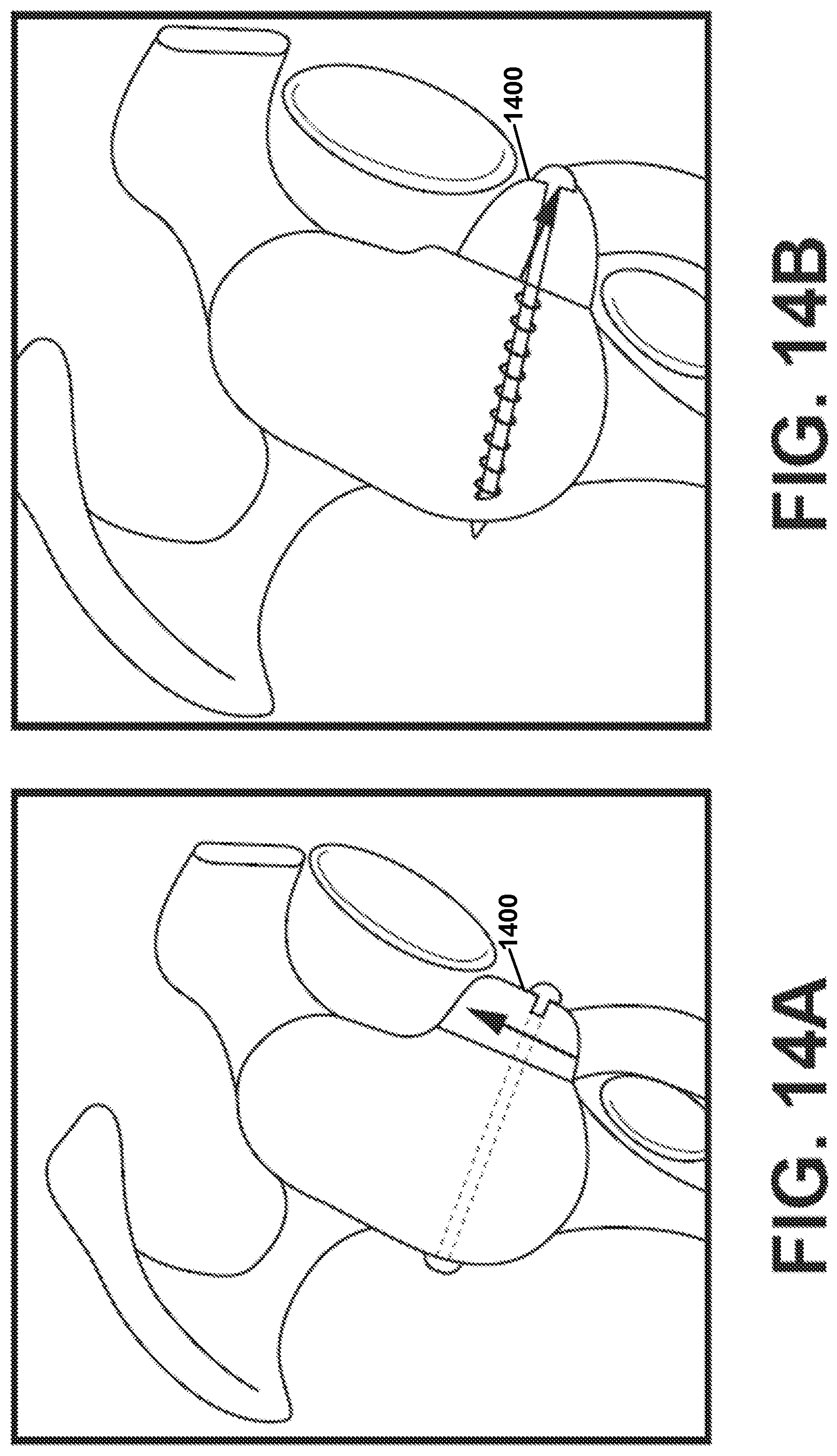 Patent US12303207 Figure 14 – Automated planning of shoulder stability enhancement surgeries