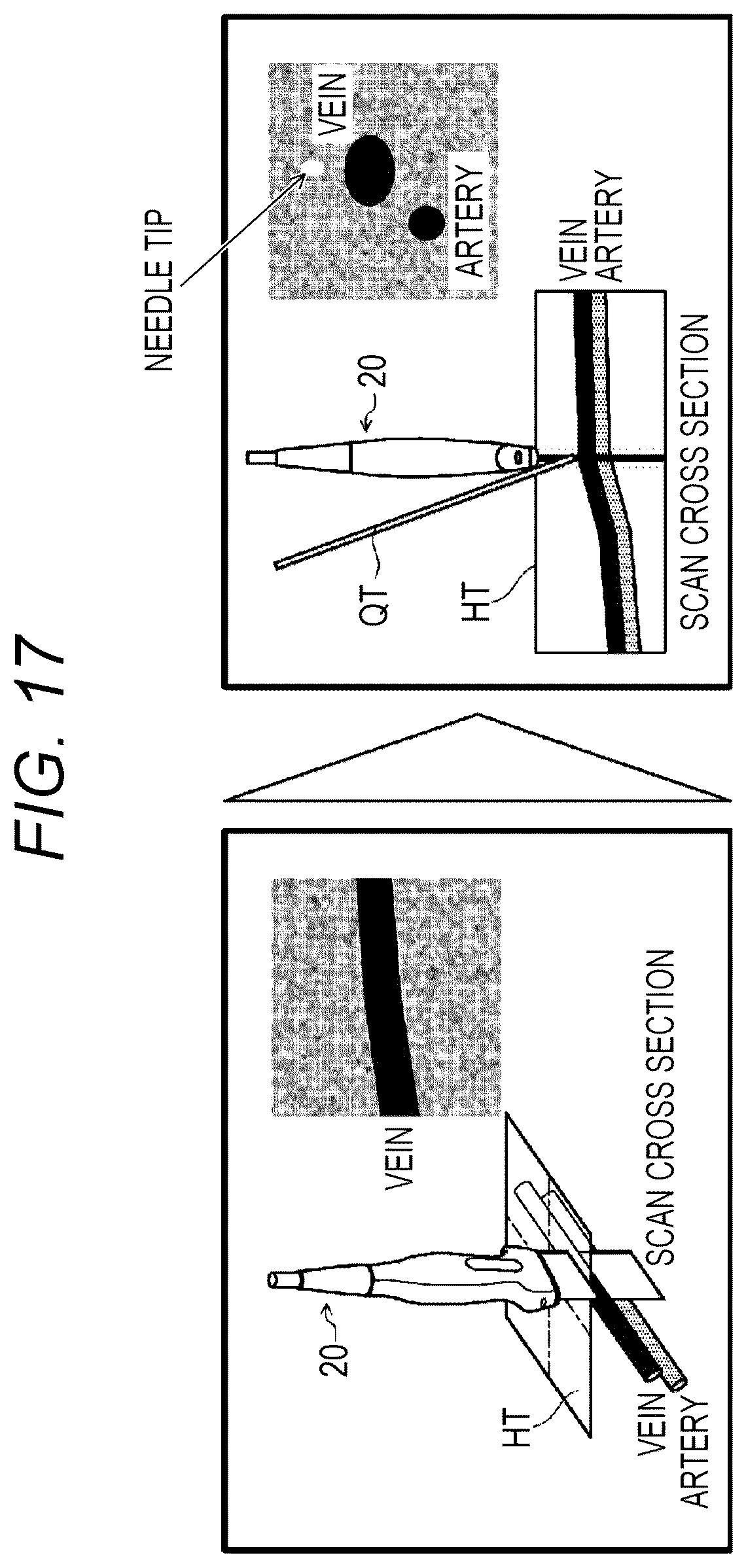 Patent US12303212 Figure 17 – Ultrasonic diagnostic apparatus, ultrasonic probe, and attachment for ultrasonic probe