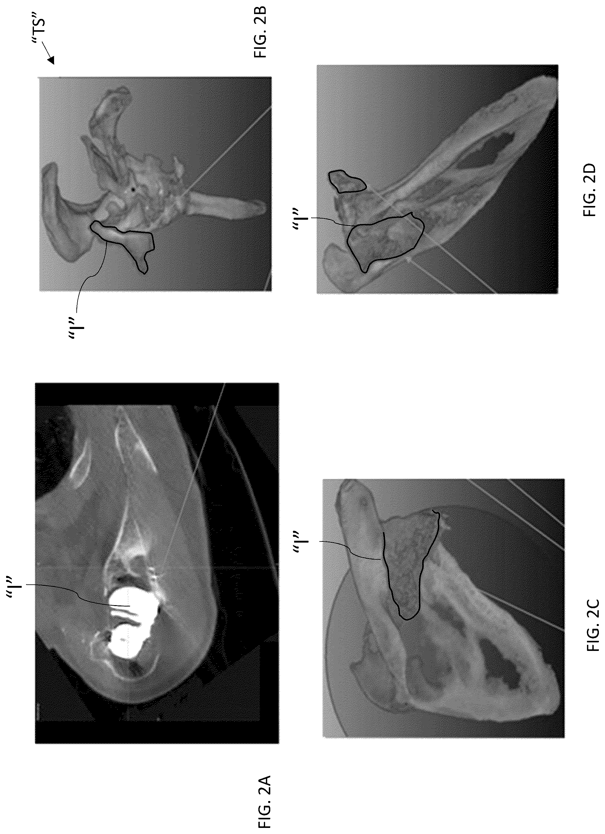 Patent US12303213 Figure 2 – Preoperative imaging combined with intraoperative navigation before and after removal of an implant from a surgical site to create a composite surgical three dimensional structural dataset