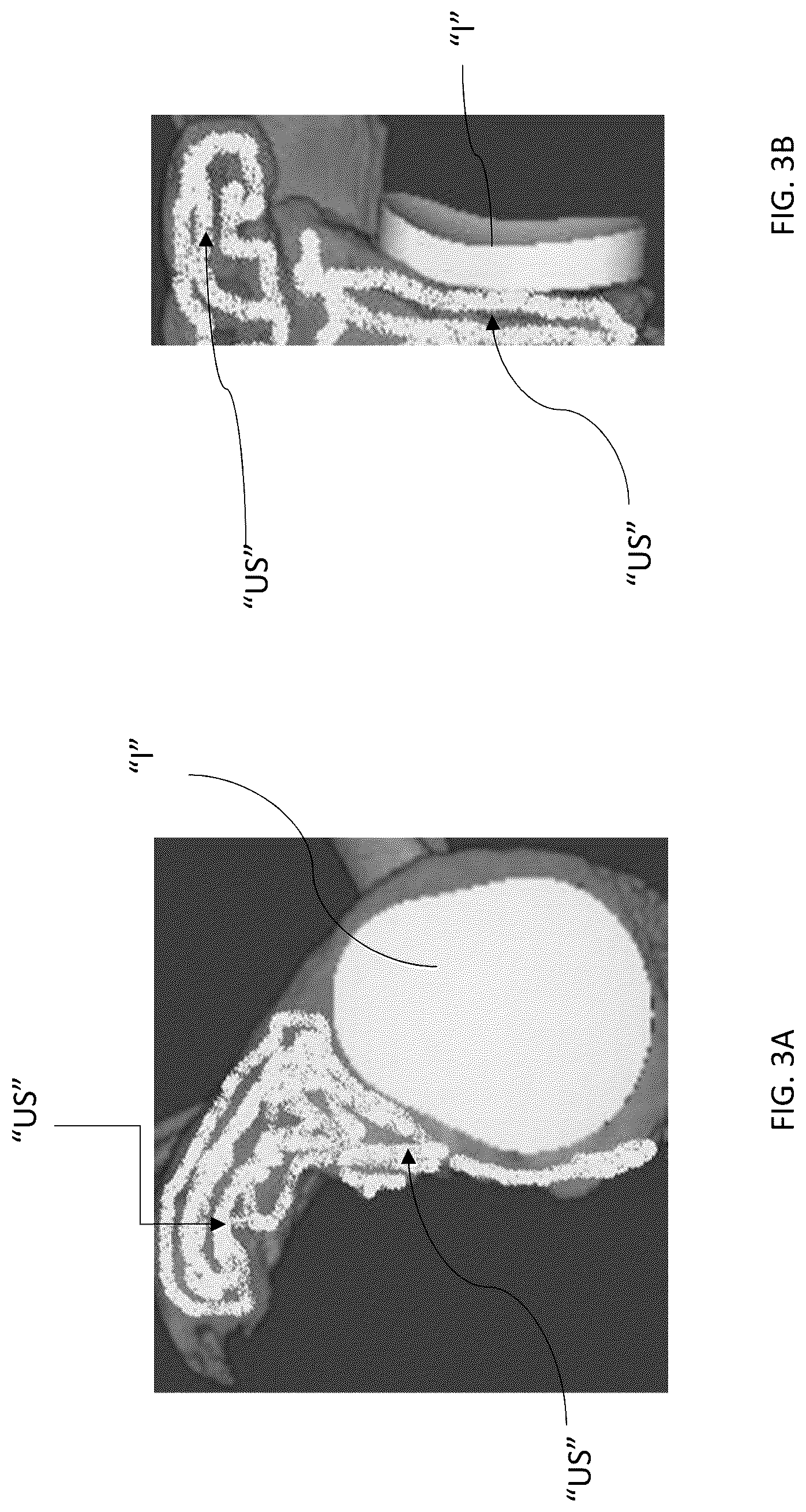 Patent US12303213 Figure 3 – Preoperative imaging combined with intraoperative navigation before and after removal of an implant from a surgical site to create a composite surgical three dimensional structural dataset