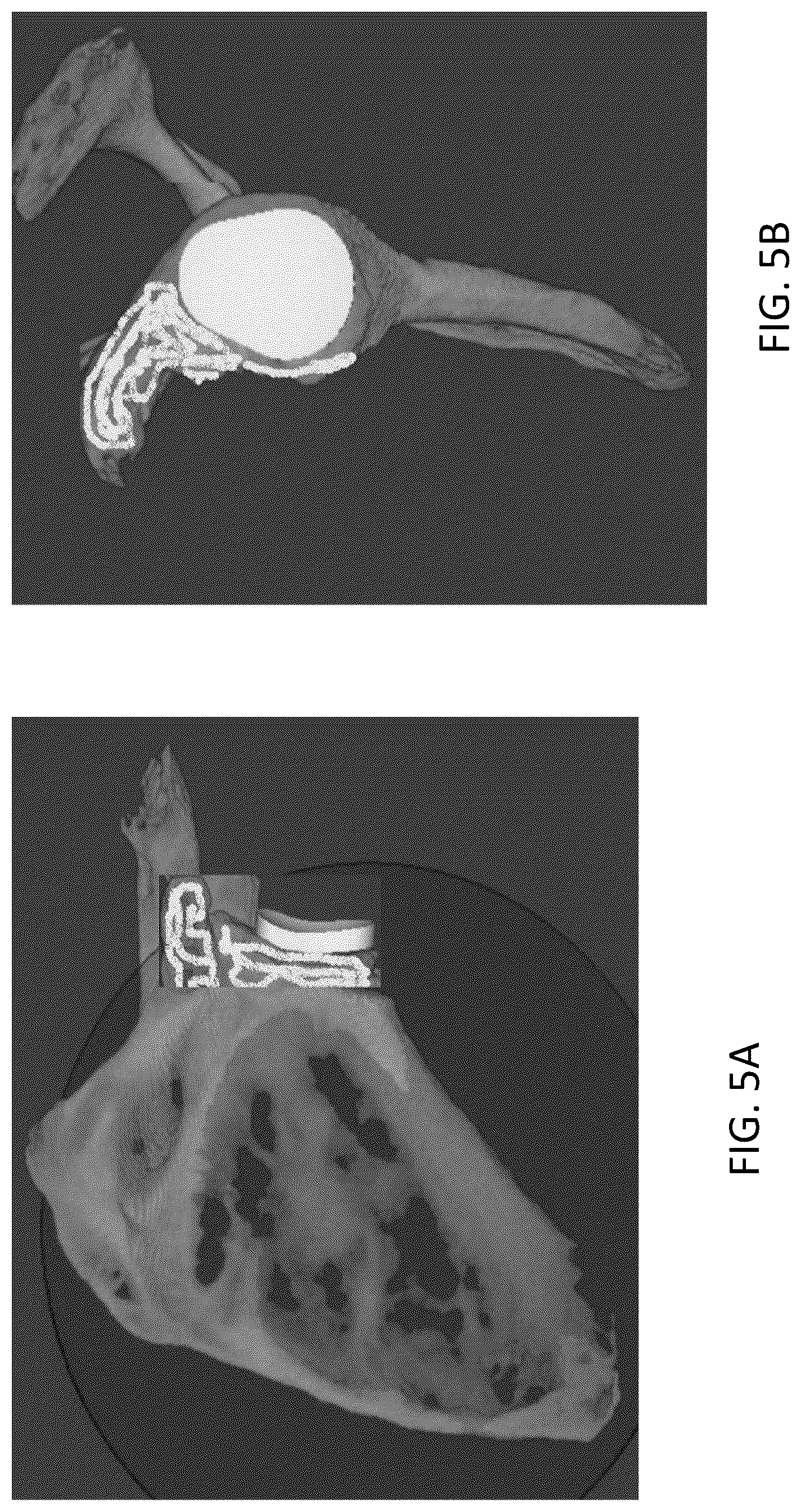 Patent US12303213 Figure 5 – Preoperative imaging combined with intraoperative navigation before and after removal of an implant from a surgical site to create a composite surgical three dimensional structural dataset