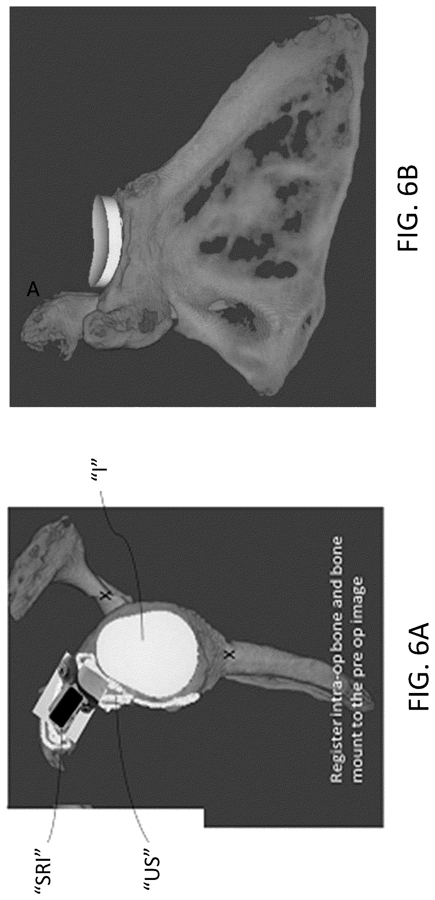 Patent US12303213 Figure 6 – Preoperative imaging combined with intraoperative navigation before and after removal of an implant from a surgical site to create a composite surgical three dimensional structural dataset