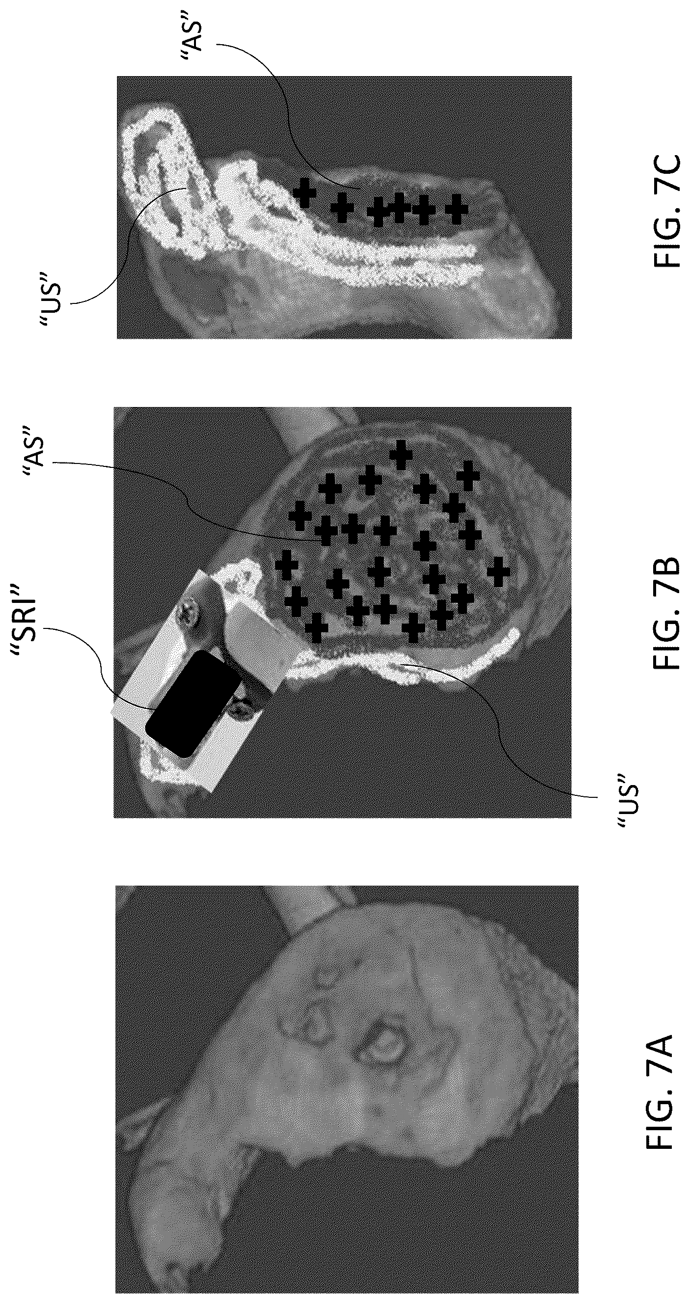 Patent US12303213 Figure 7 – Preoperative imaging combined with intraoperative navigation before and after removal of an implant from a surgical site to create a composite surgical three dimensional structural dataset