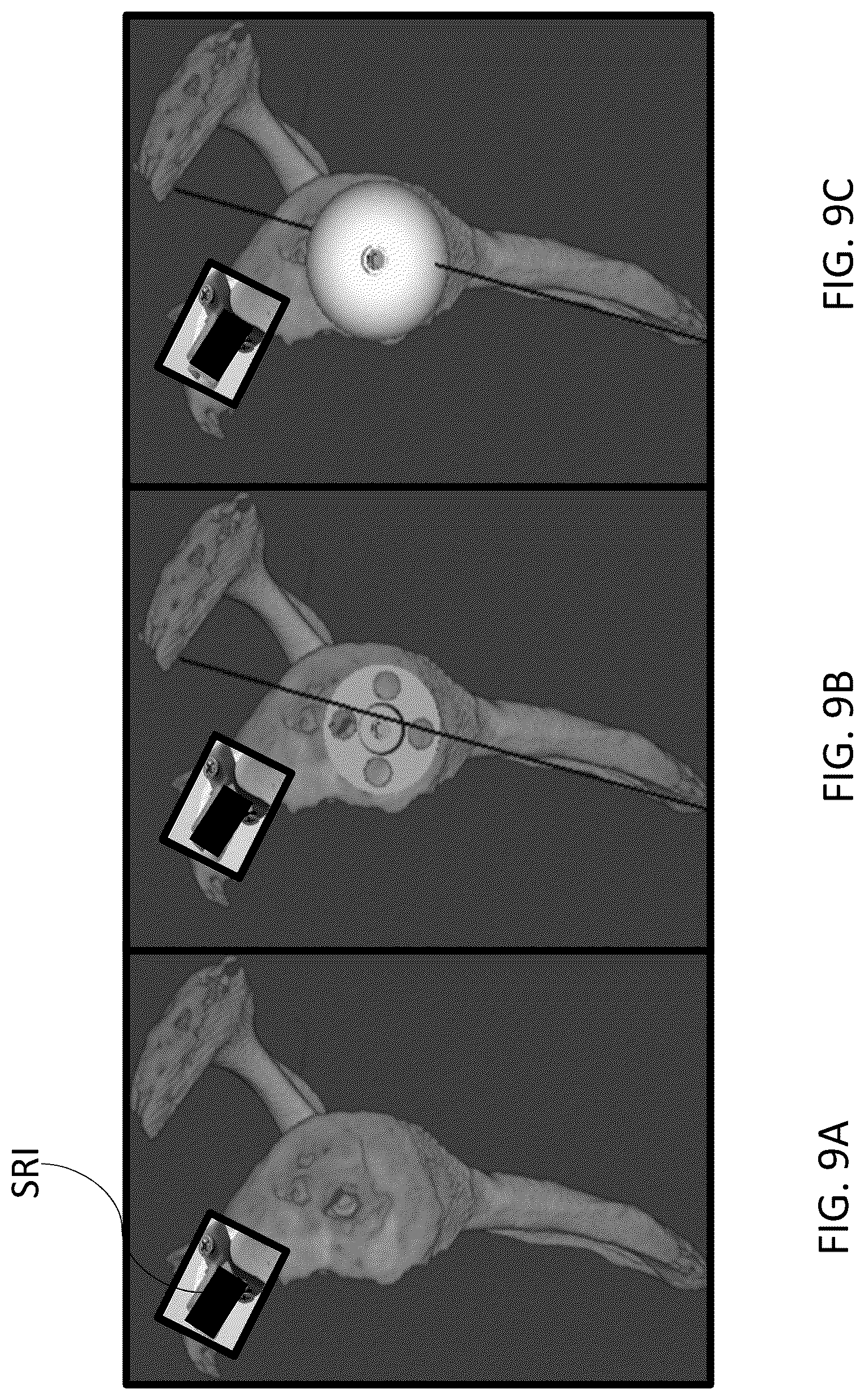Patent US12303213 Figure 9 – Preoperative imaging combined with intraoperative navigation before and after removal of an implant from a surgical site to create a composite surgical three dimensional structural dataset