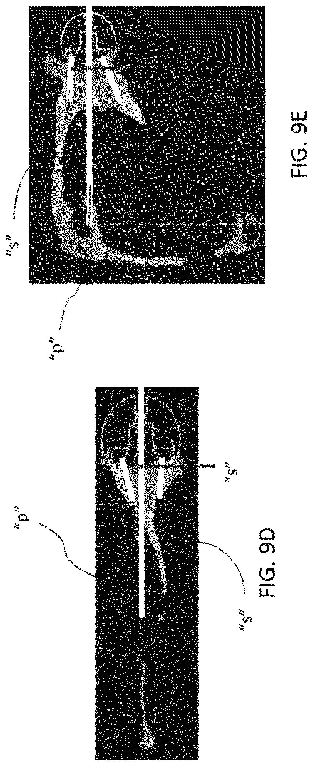 Patent US12303213 Figure 10 – Preoperative imaging combined with intraoperative navigation before and after removal of an implant from a surgical site to create a composite surgical three dimensional structural dataset