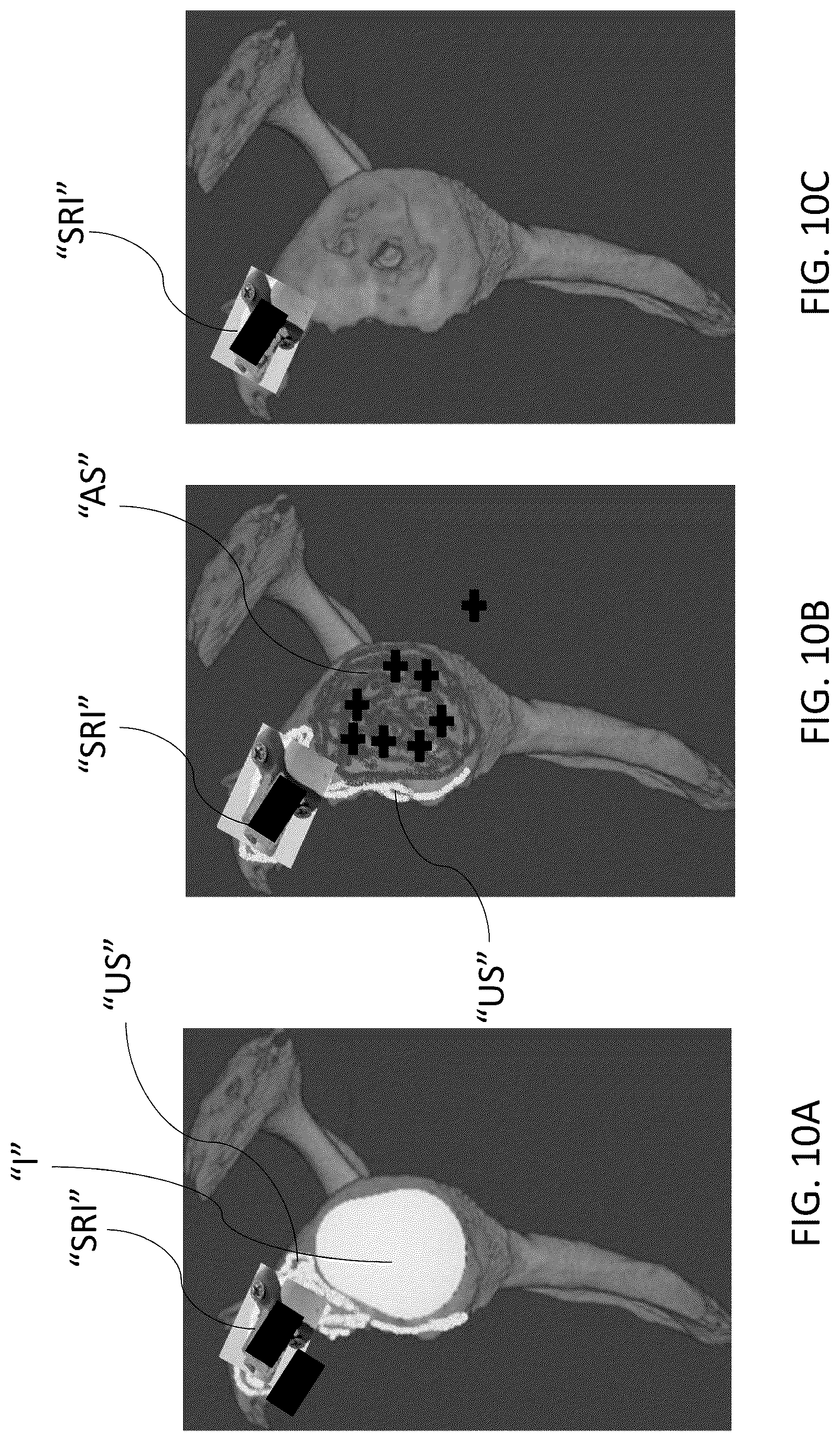 Patent US12303213 Figure 11 – Preoperative imaging combined with intraoperative navigation before and after removal of an implant from a surgical site to create a composite surgical three dimensional structural dataset