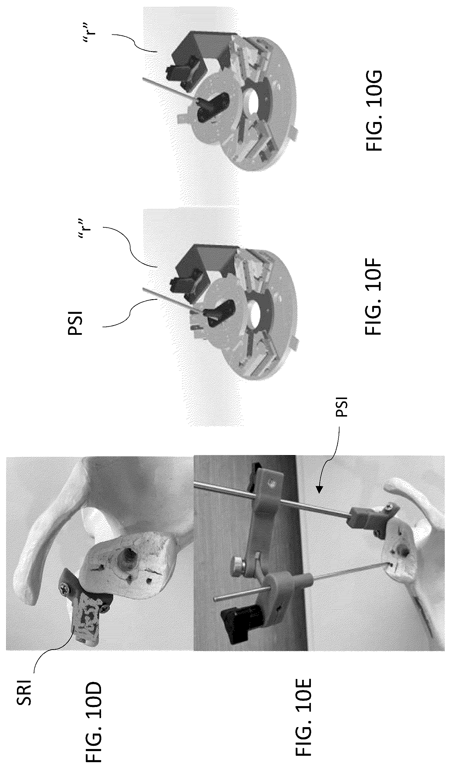 Patent US12303213 Figure 12 – Preoperative imaging combined with intraoperative navigation before and after removal of an implant from a surgical site to create a composite surgical three dimensional structural dataset