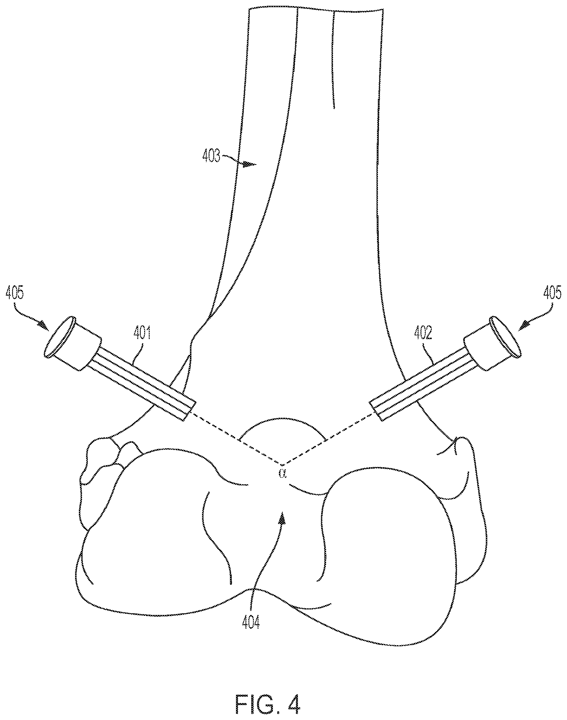 Patent US12303216 Figure 4 – Surgical tracking methods and fiber optic shape sensing devices thereof
