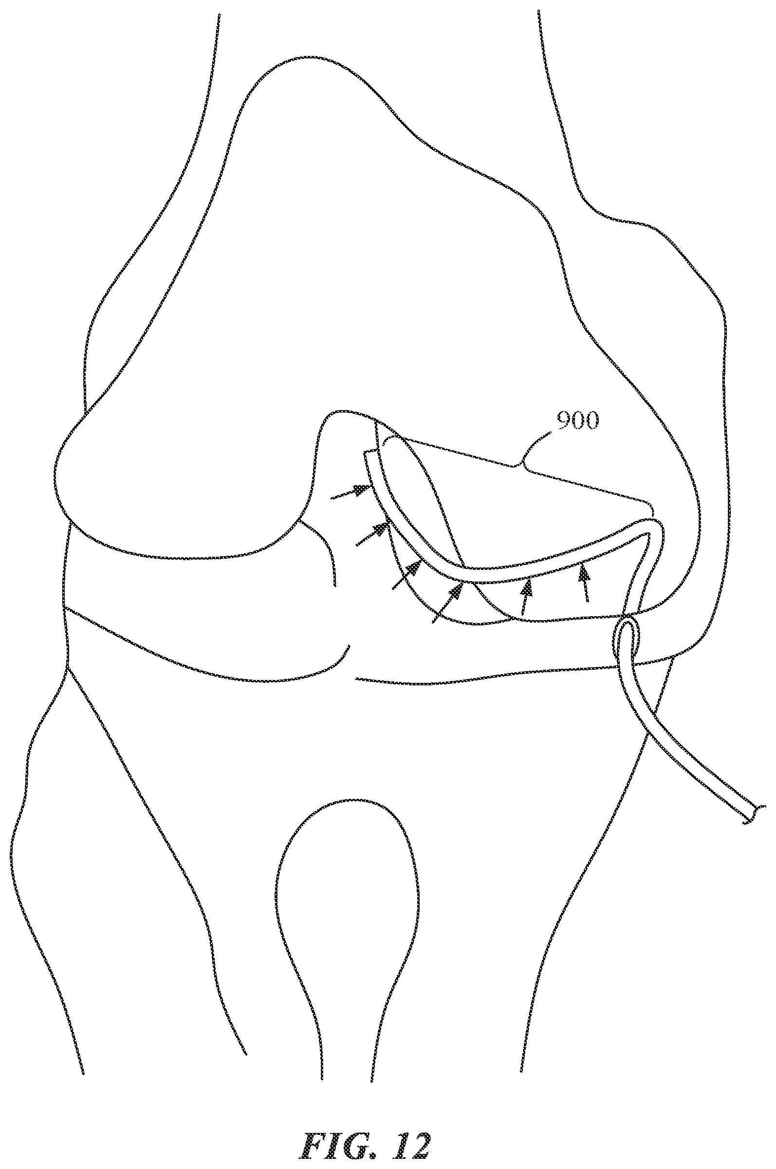 Patent US12303216 Figure 17 – Surgical tracking methods and fiber optic shape sensing devices thereof