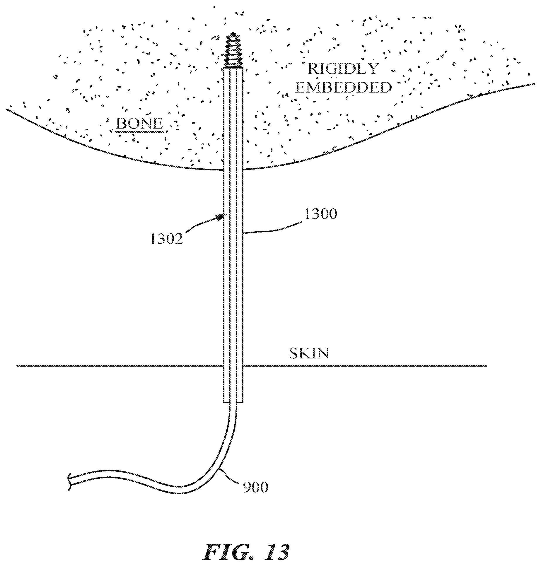 Patent US12303216 Figure 18 – Surgical tracking methods and fiber optic shape sensing devices thereof