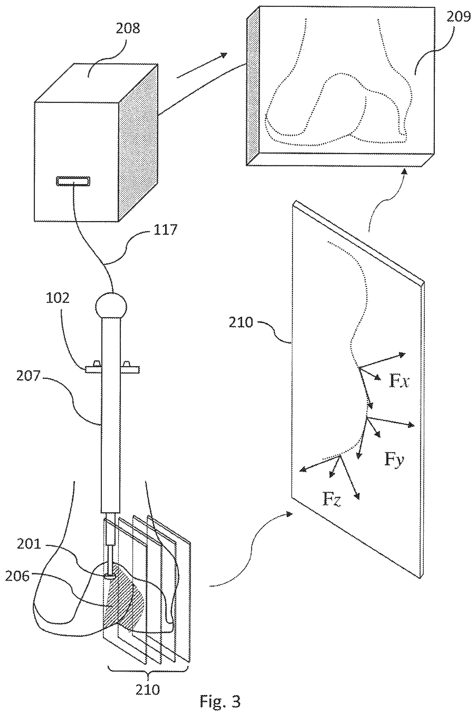 Patent US12303219 Figure 3 – Miniature bone-mounted robot for IN-SITU three-dimensional bioprinting