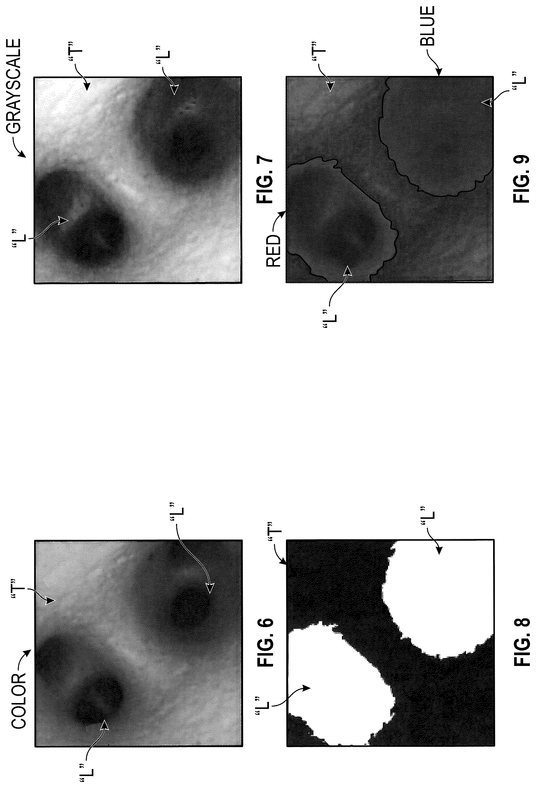 Patent US12303220 Figure 5 – Autonomous endobronchial access with an EM guided catheter