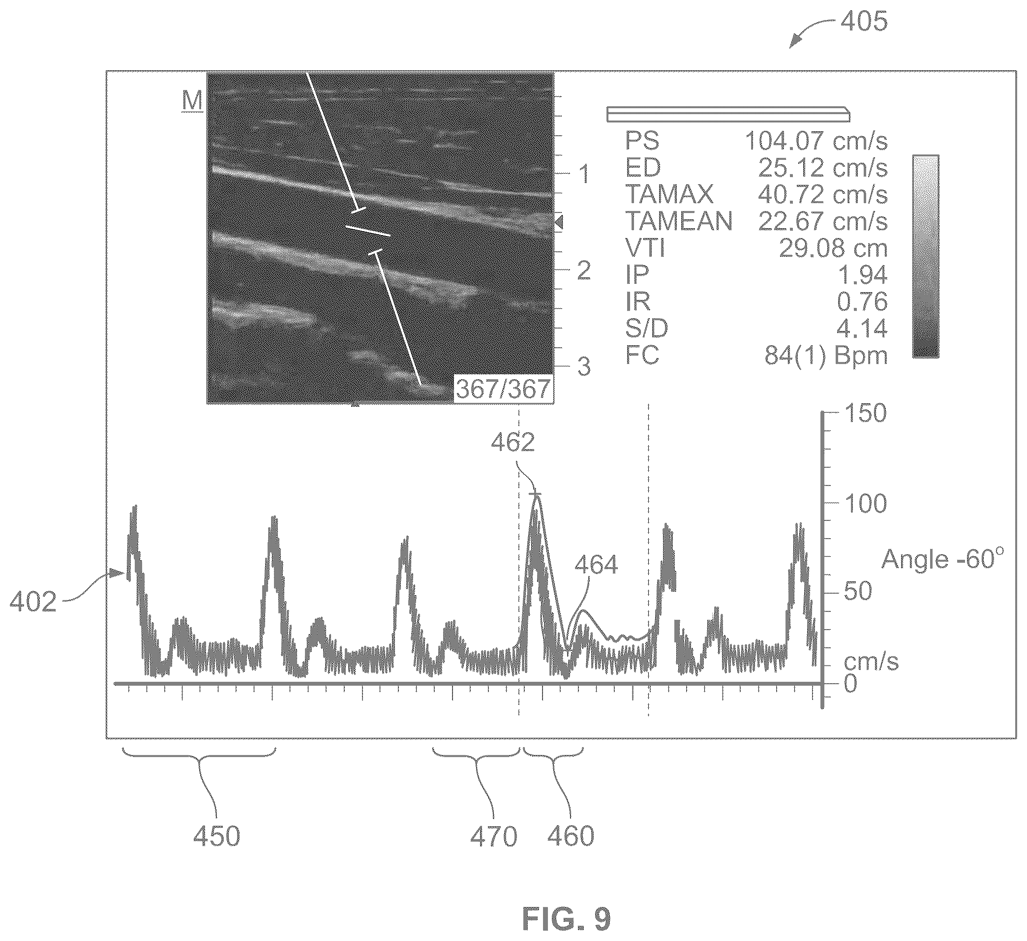 Patent US12303240 Figure 7 – Non-invasive non-compressive blood pressure monitoring device