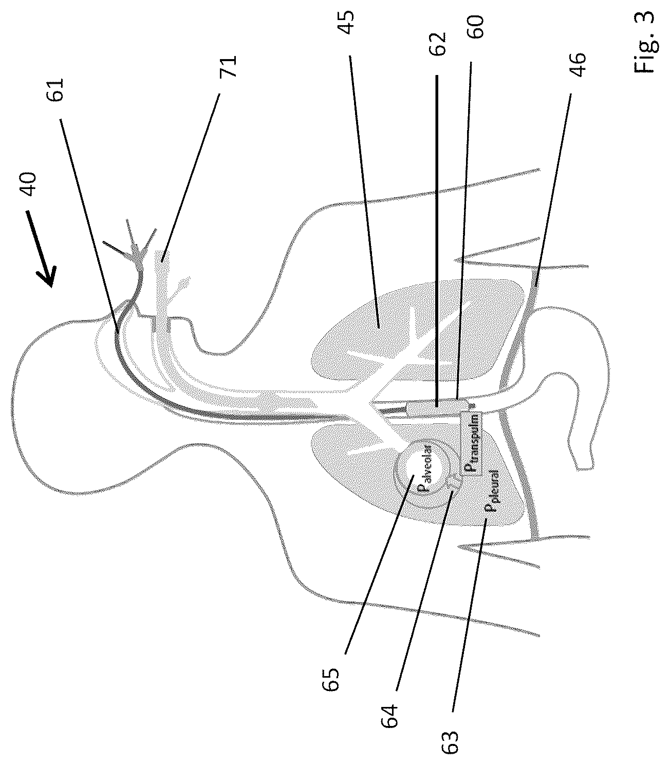Patent US12303244 Figure 3 – System for recording the breathing efforts of a patient