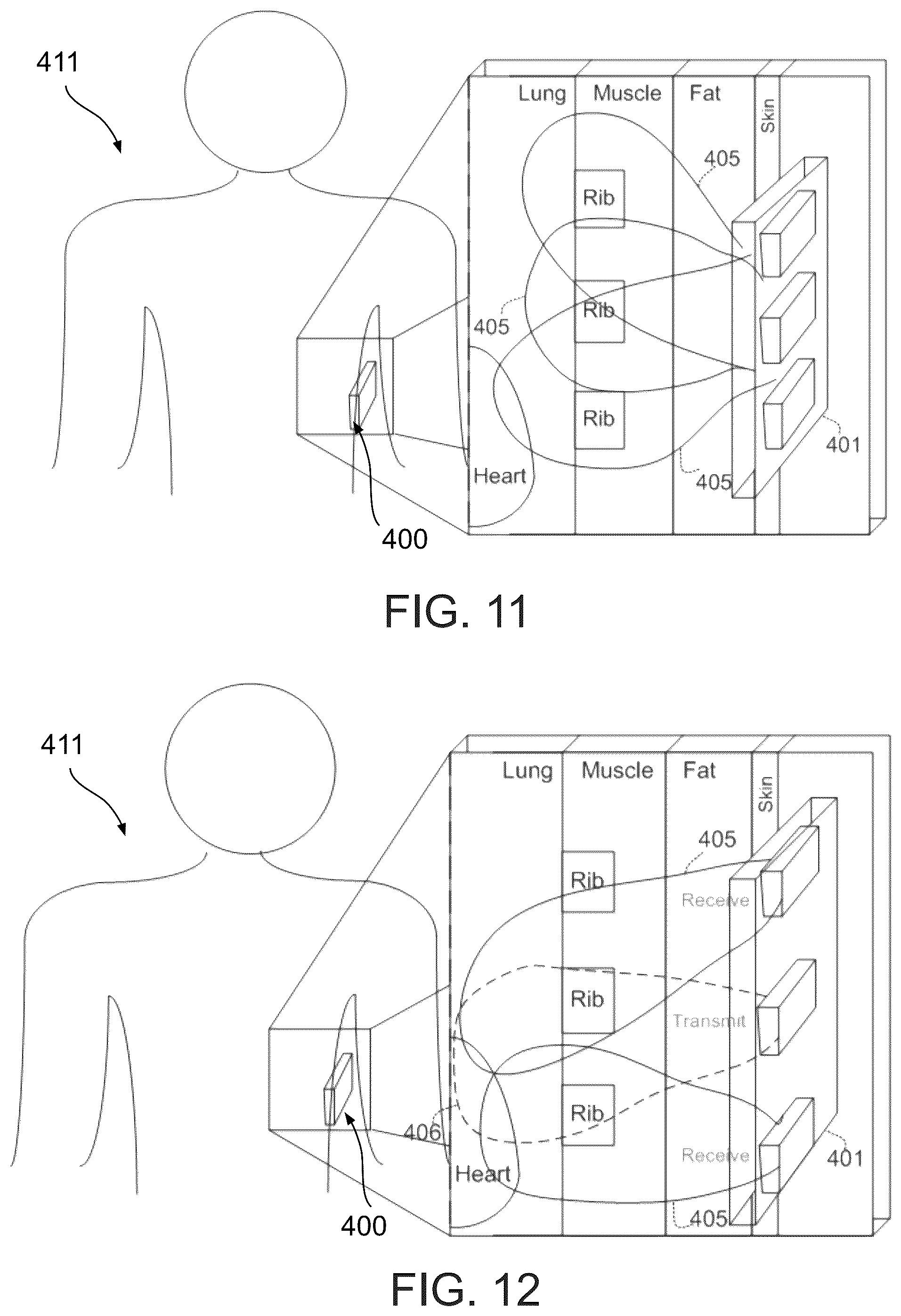 Patent US12303245 Figure 12 – Method and system for monitoring thoracic tissue fluid