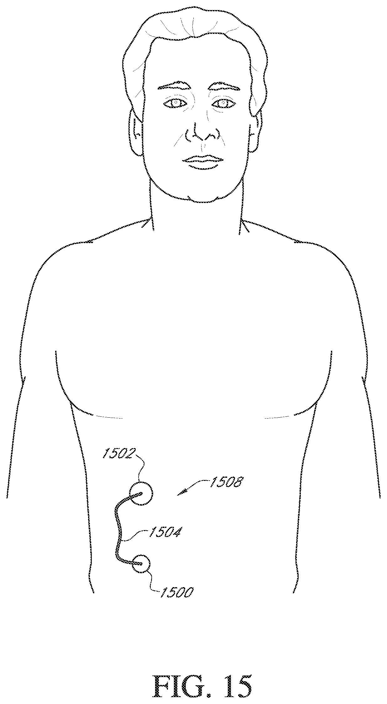 Patent US12303262 Figure 18 – Advanced continuous analyte monitoring system