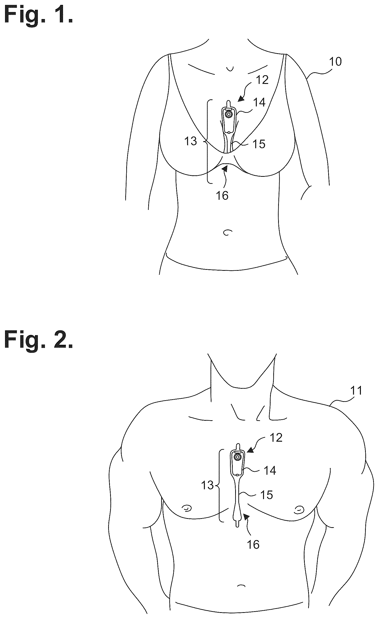 Patent US12303278 Figure 1 – Electrocardiography patch