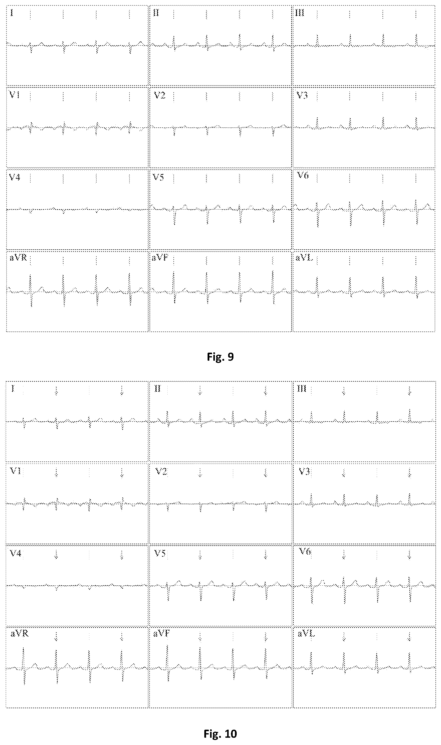 Patent US12303280 Figure 4 – Method for determining electrical activity of cardiac muscle