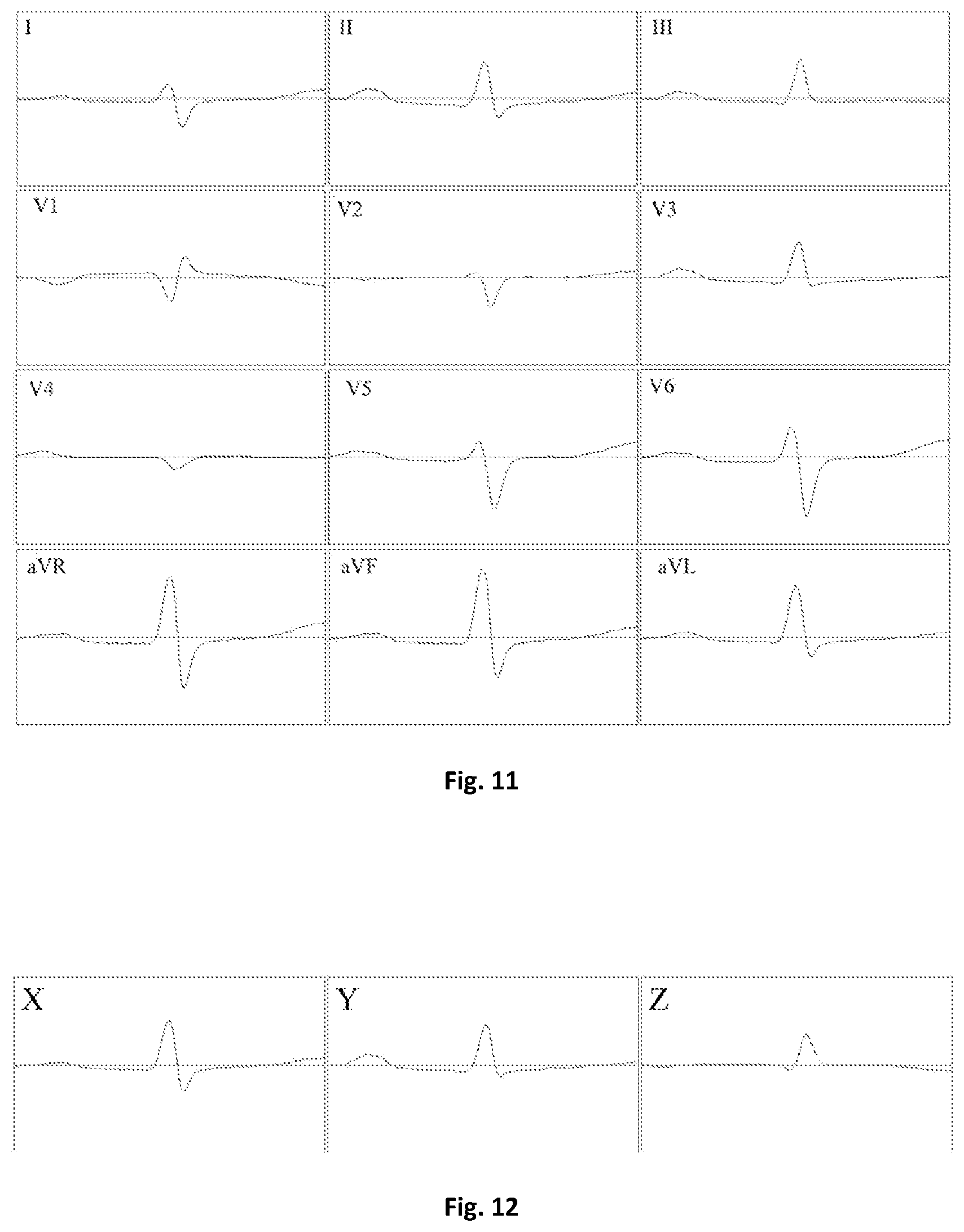 Patent US12303280 Figure 5 – Method for determining electrical activity of cardiac muscle
