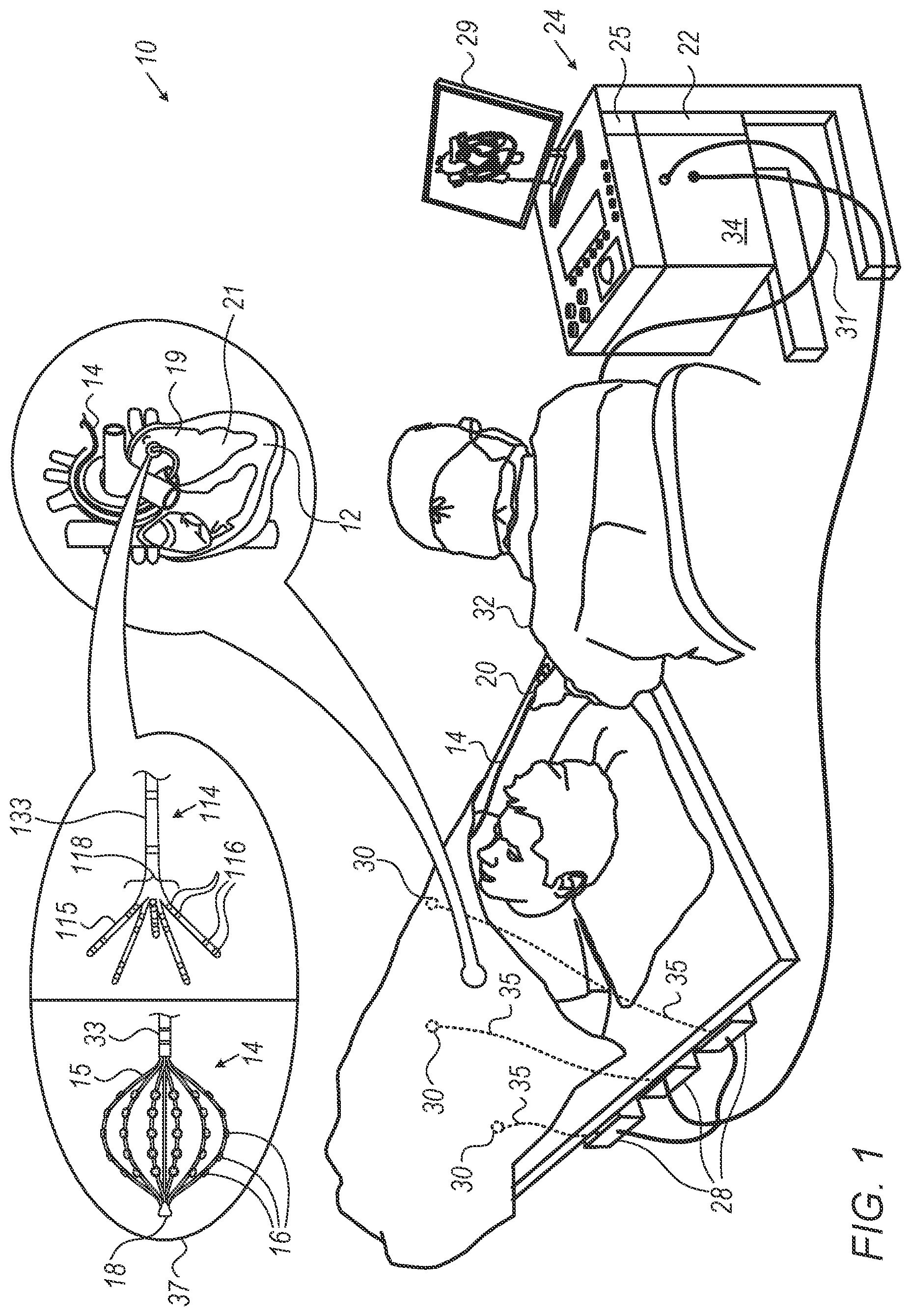 Patent US12303281 Figure 1 – Mapping resolution of electrophysiological (EP) wave propagating on the surface of patient heart