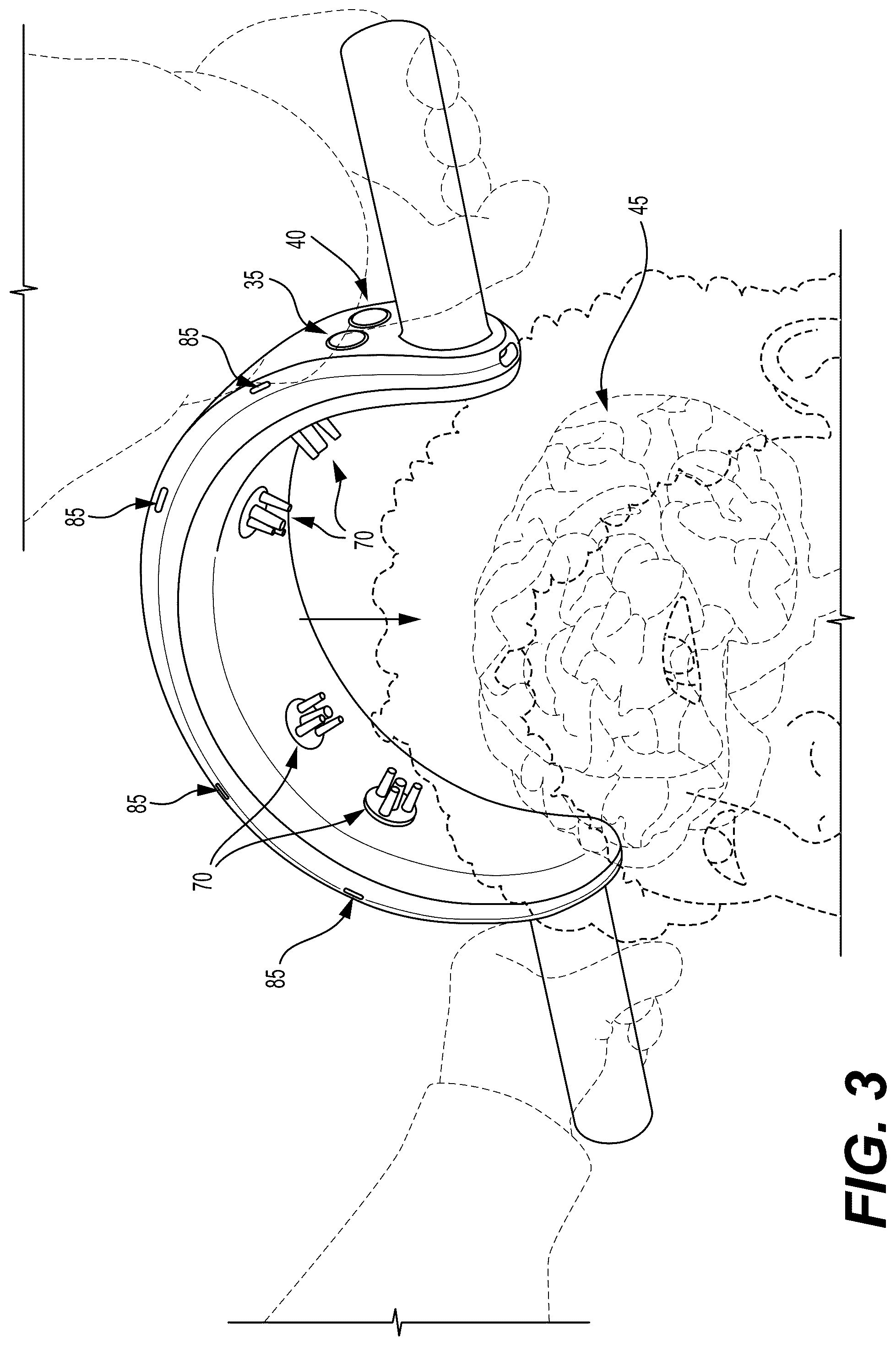 Patent US12303284 Figure 3 – System and method for detecting brain abnormalities using backscattered radiation