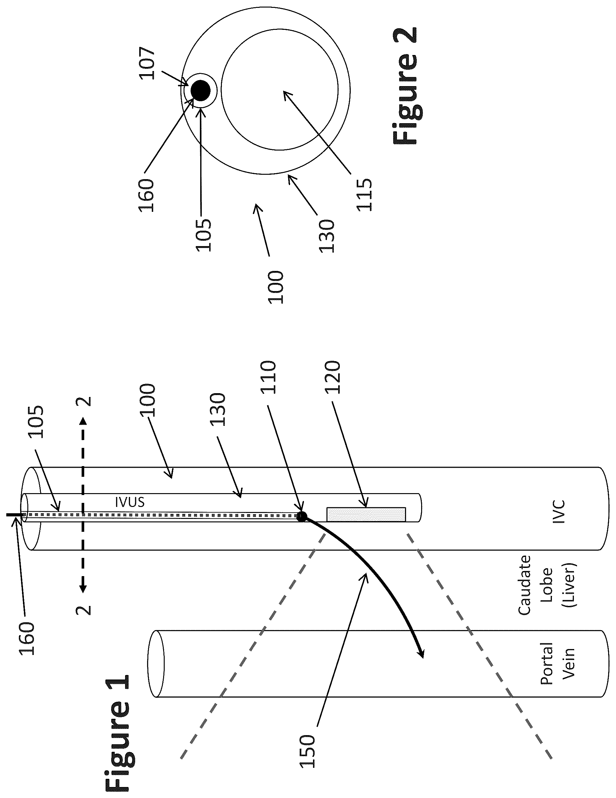 Patent US12303319 Figure 1 – Intravascular ultrasound needle guide