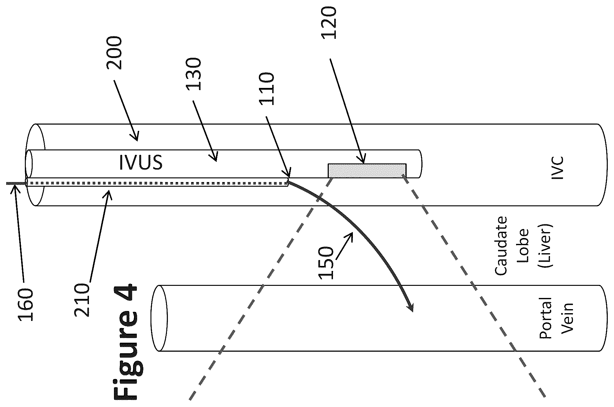 Patent US12303319 Figure 3 – Intravascular ultrasound needle guide