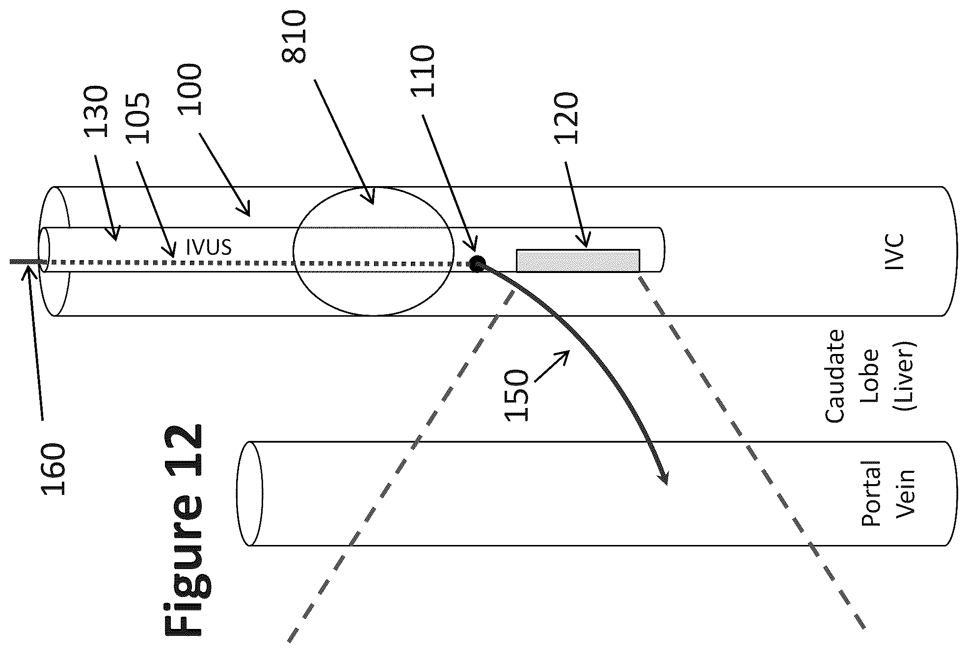 Patent US12303319 Figure 9 – Intravascular ultrasound needle guide