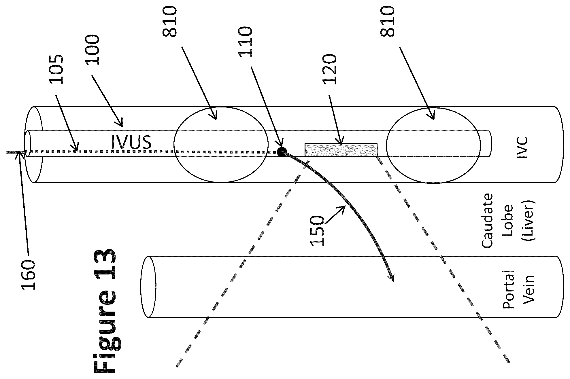 Patent US12303319 Figure 10 – Intravascular ultrasound needle guide
