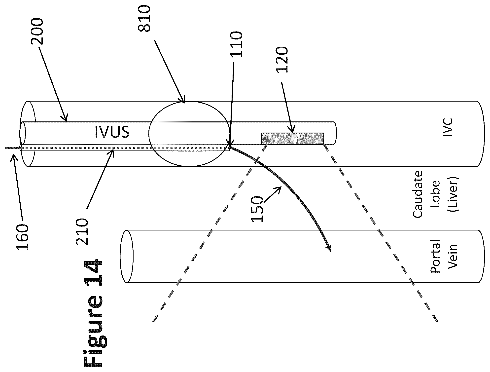 Patent US12303319 Figure 11 – Intravascular ultrasound needle guide