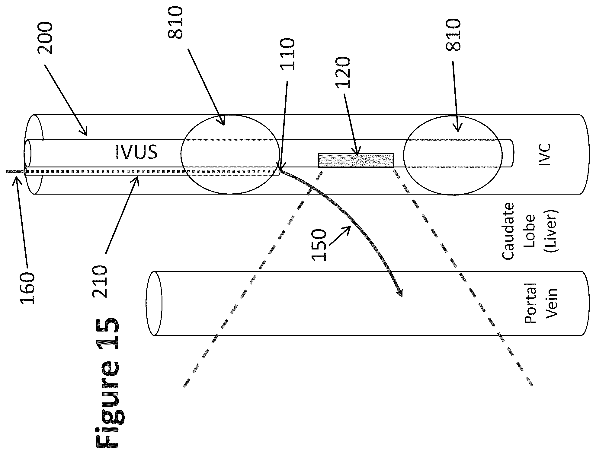 Patent US12303319 Figure 12 – Intravascular ultrasound needle guide