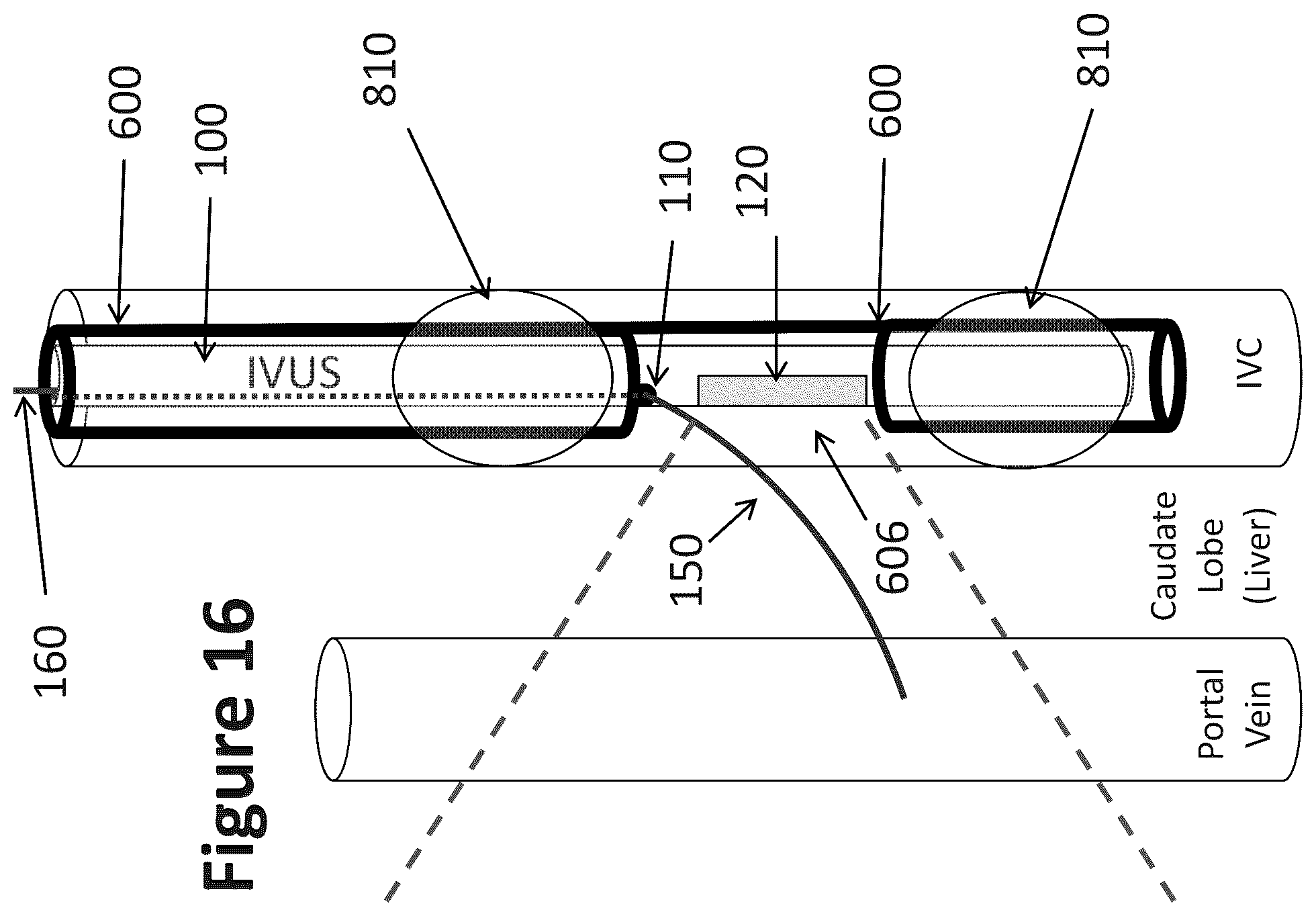 Patent US12303319 Figure 13 – Intravascular ultrasound needle guide