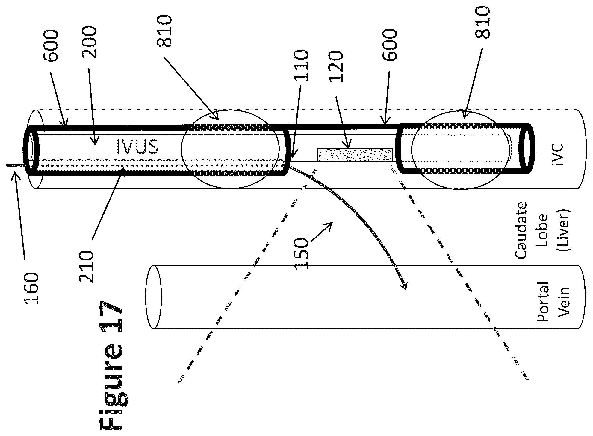 Patent US12303319 Figure 14 – Intravascular ultrasound needle guide