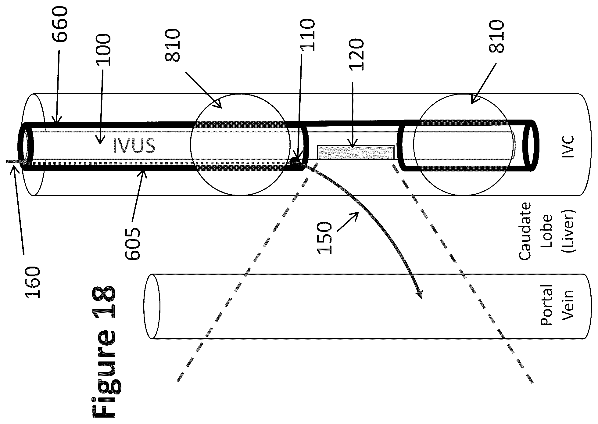 Patent US12303319 Figure 15 – Intravascular ultrasound needle guide