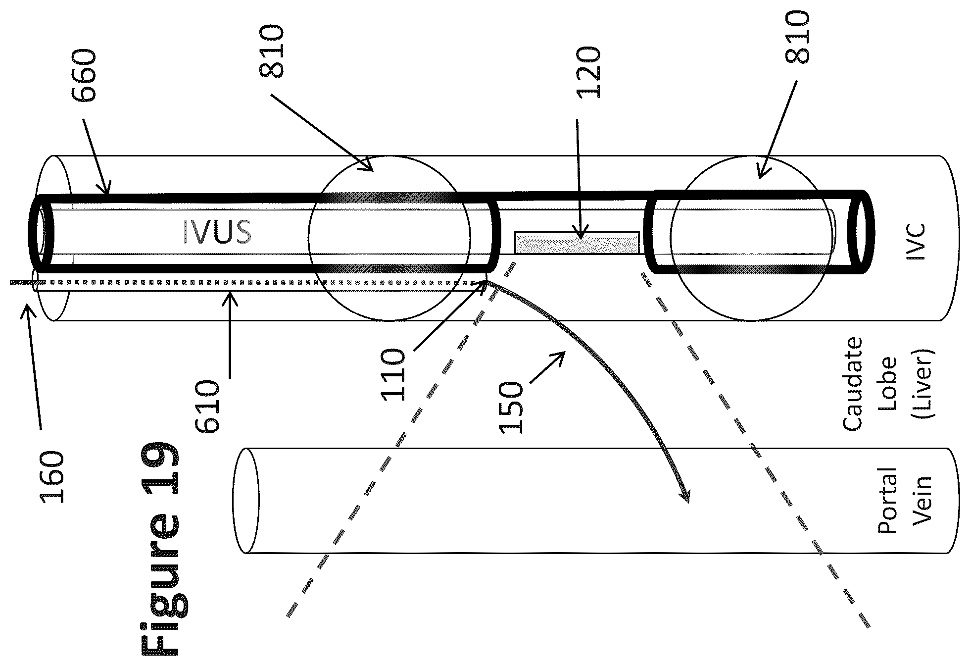 Patent US12303319 Figure 16 – Intravascular ultrasound needle guide