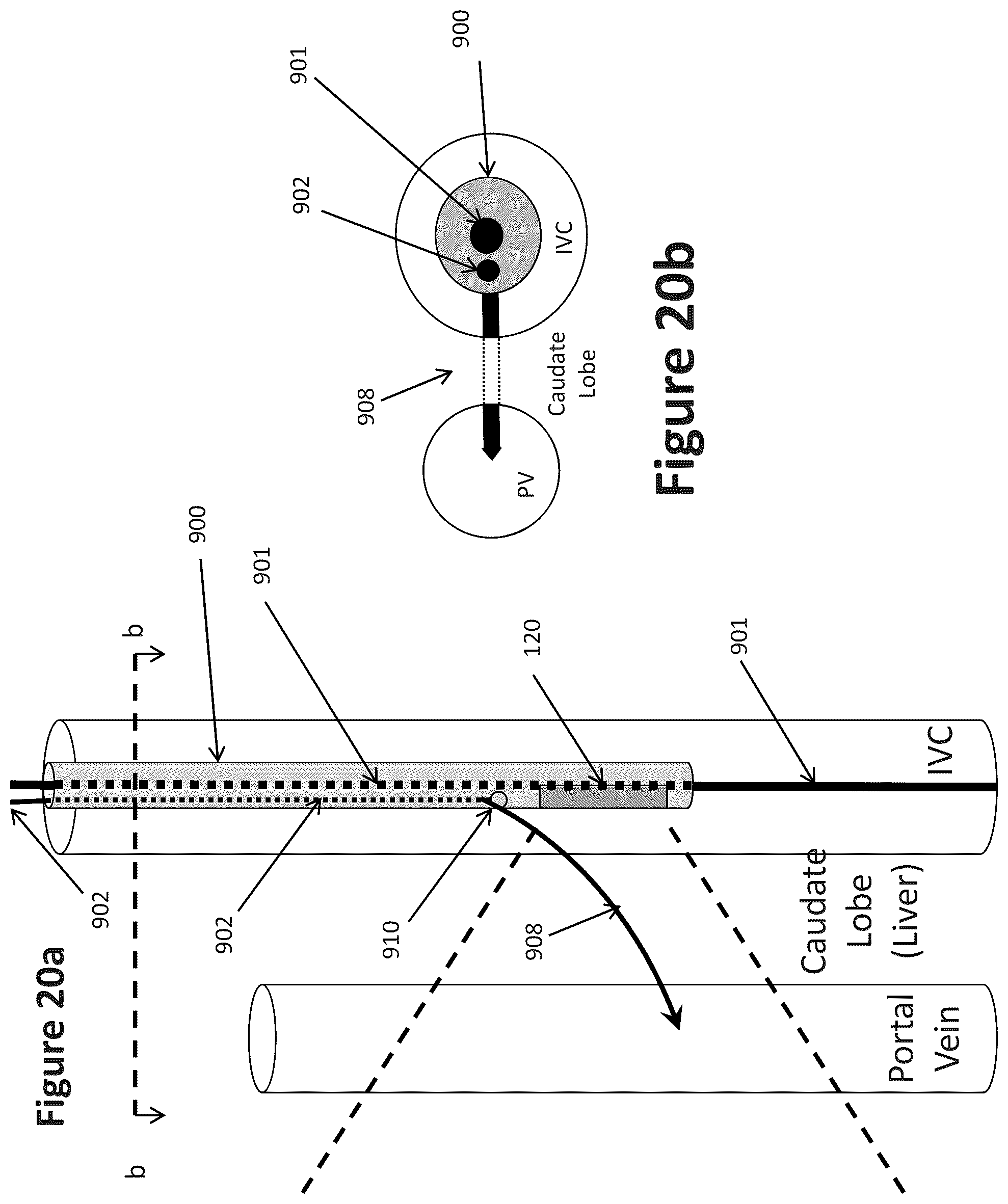 Patent US12303319 Figure 17 – Intravascular ultrasound needle guide
