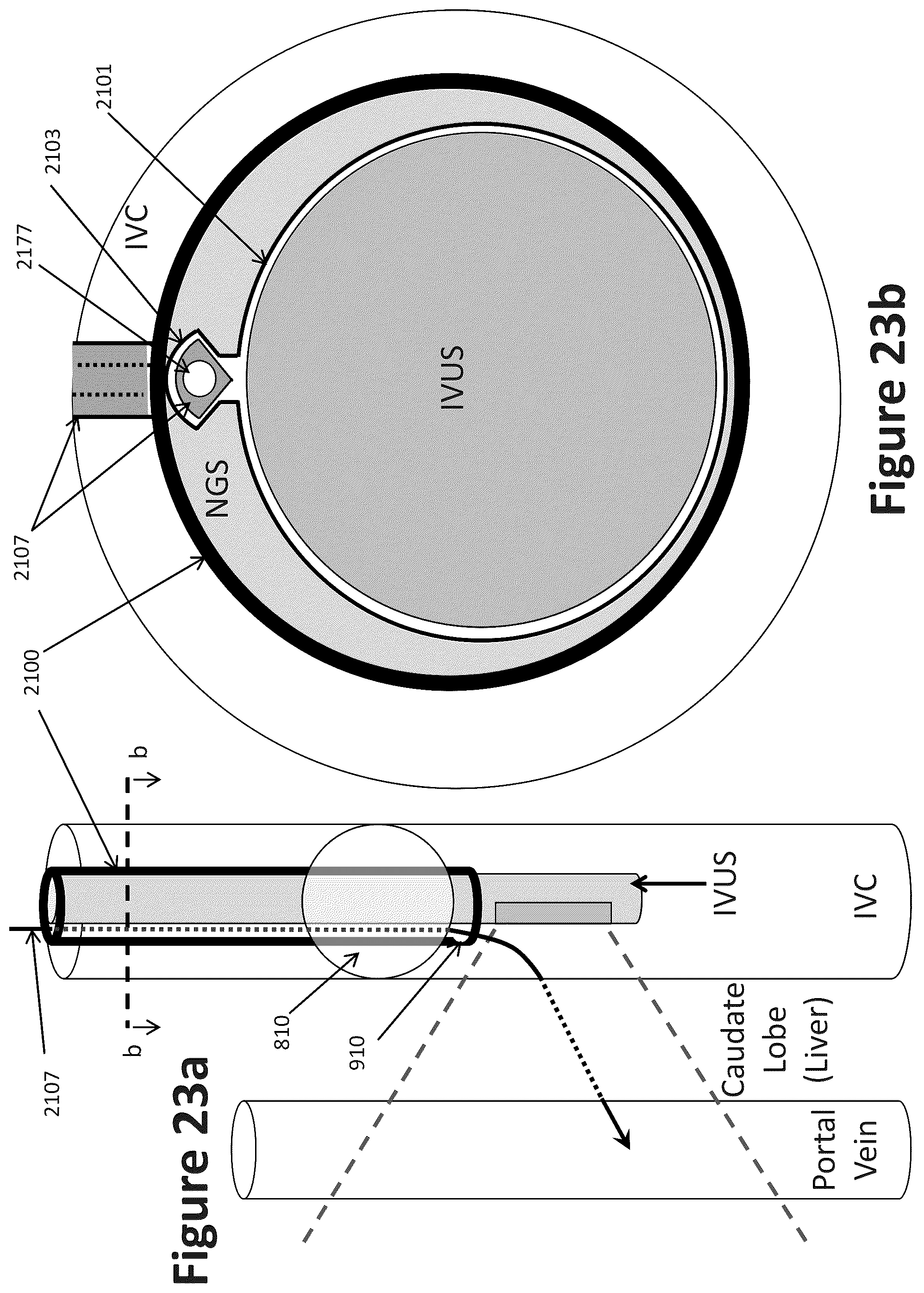 Patent US12303319 Figure 20 – Intravascular ultrasound needle guide