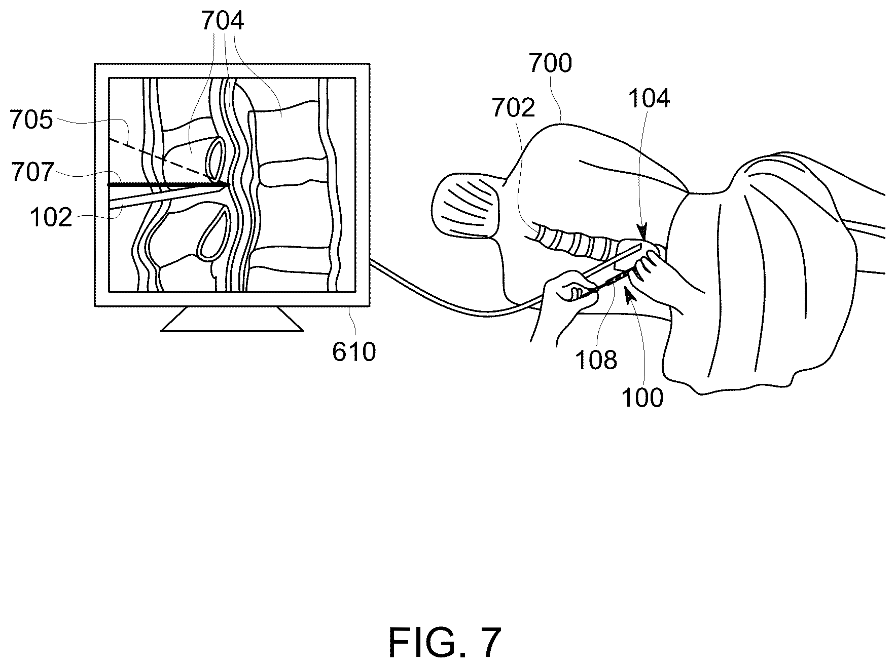 Patent US12303323 Figure 9 – Ultrasound probe with an integrated needle assembly and a computer program product, a method and a system for providing a path for inserting a needle of the ultrasound probe