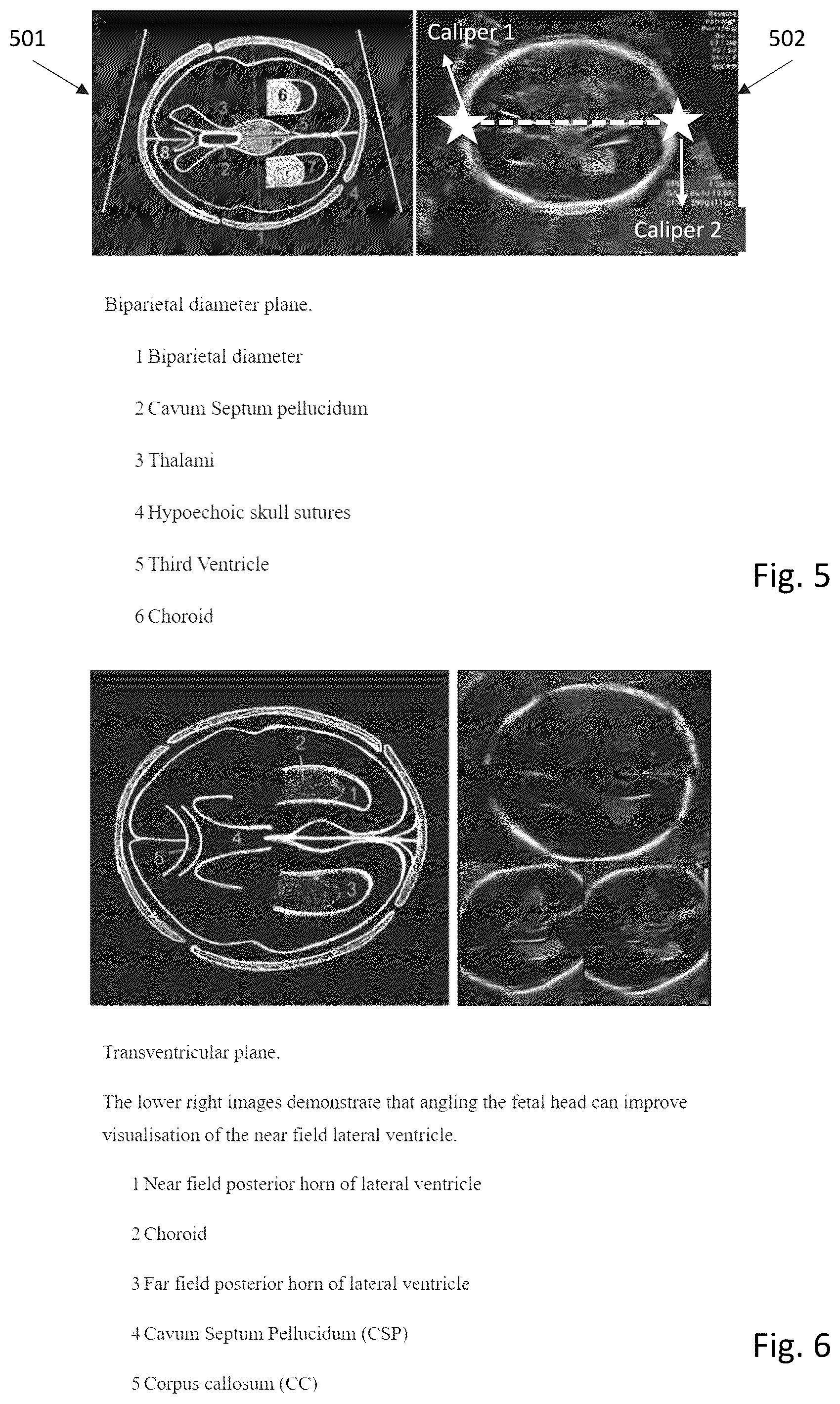 Patent US12303326 Figure 5 – Method of determining scan planes in the acquisition of ultrasound images and ultrasound system for the implementation of the method