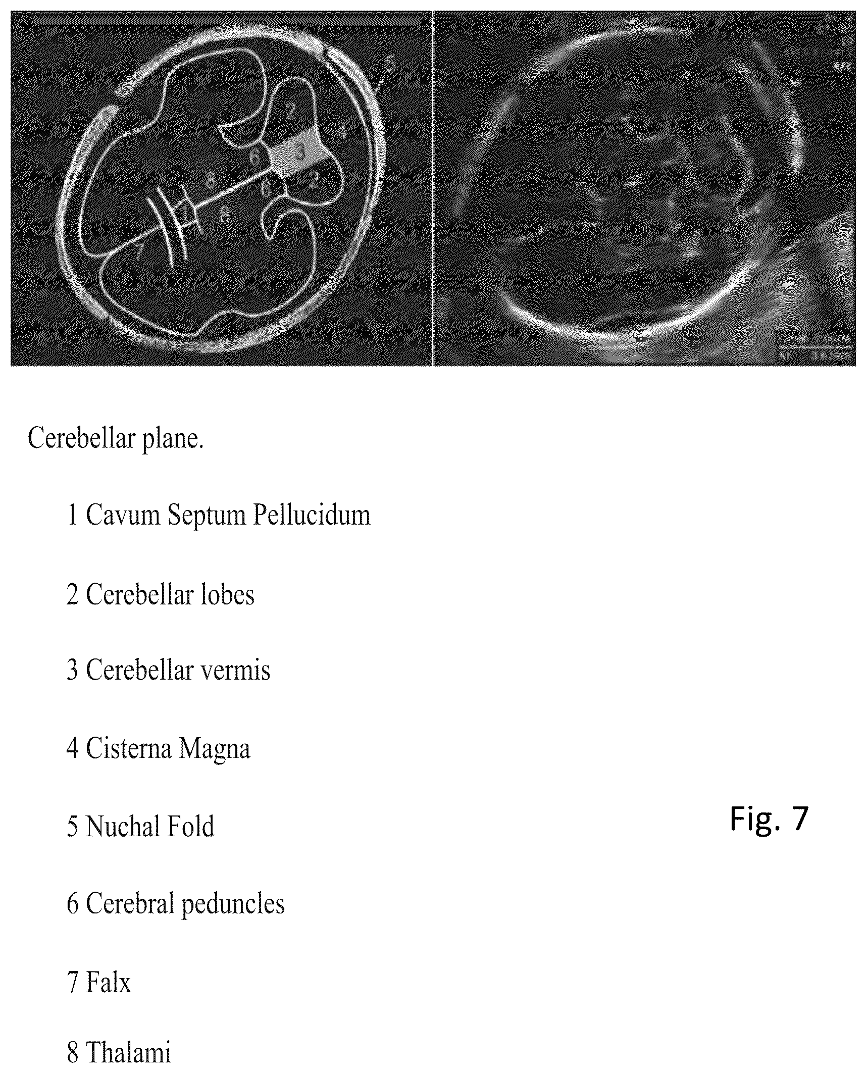 Patent US12303326 Figure 6 – Method of determining scan planes in the acquisition of ultrasound images and ultrasound system for the implementation of the method