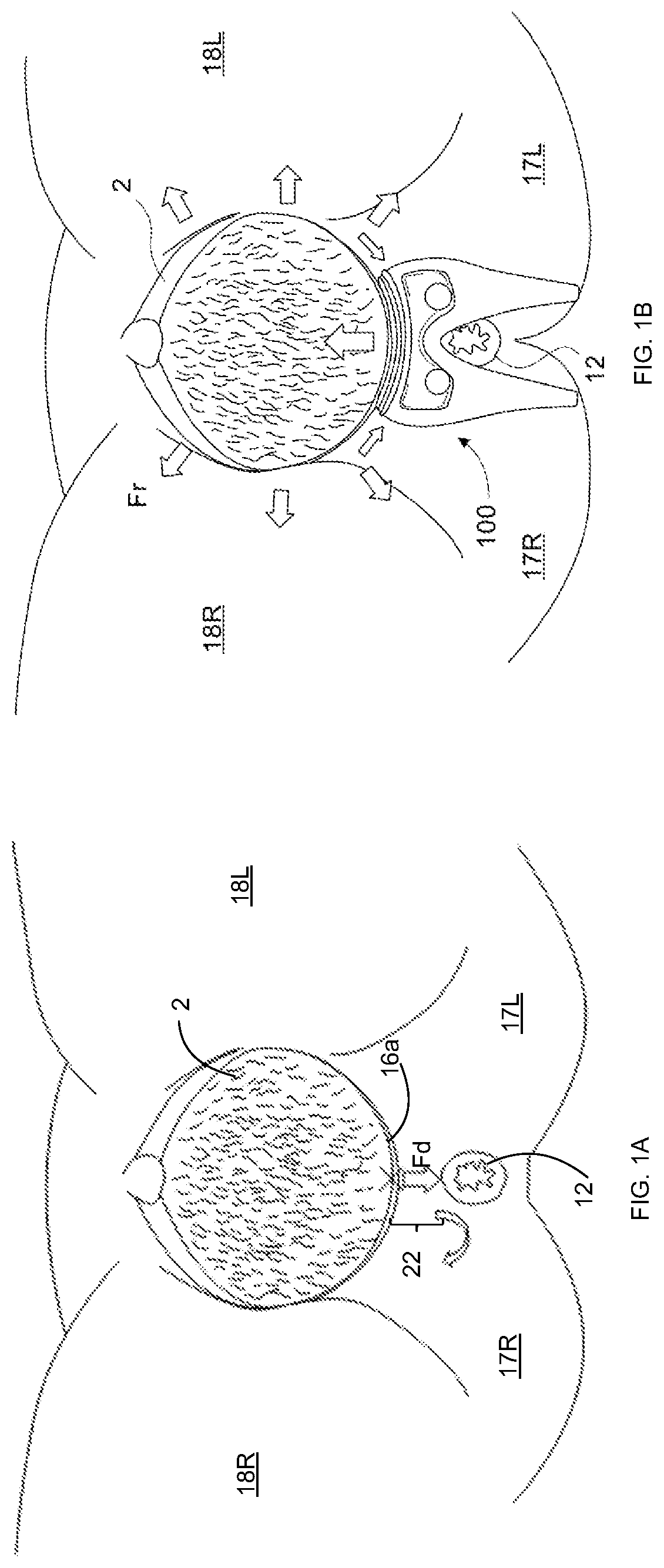 Patent US12303337 Figure 1 – Perineal protection device, system and method