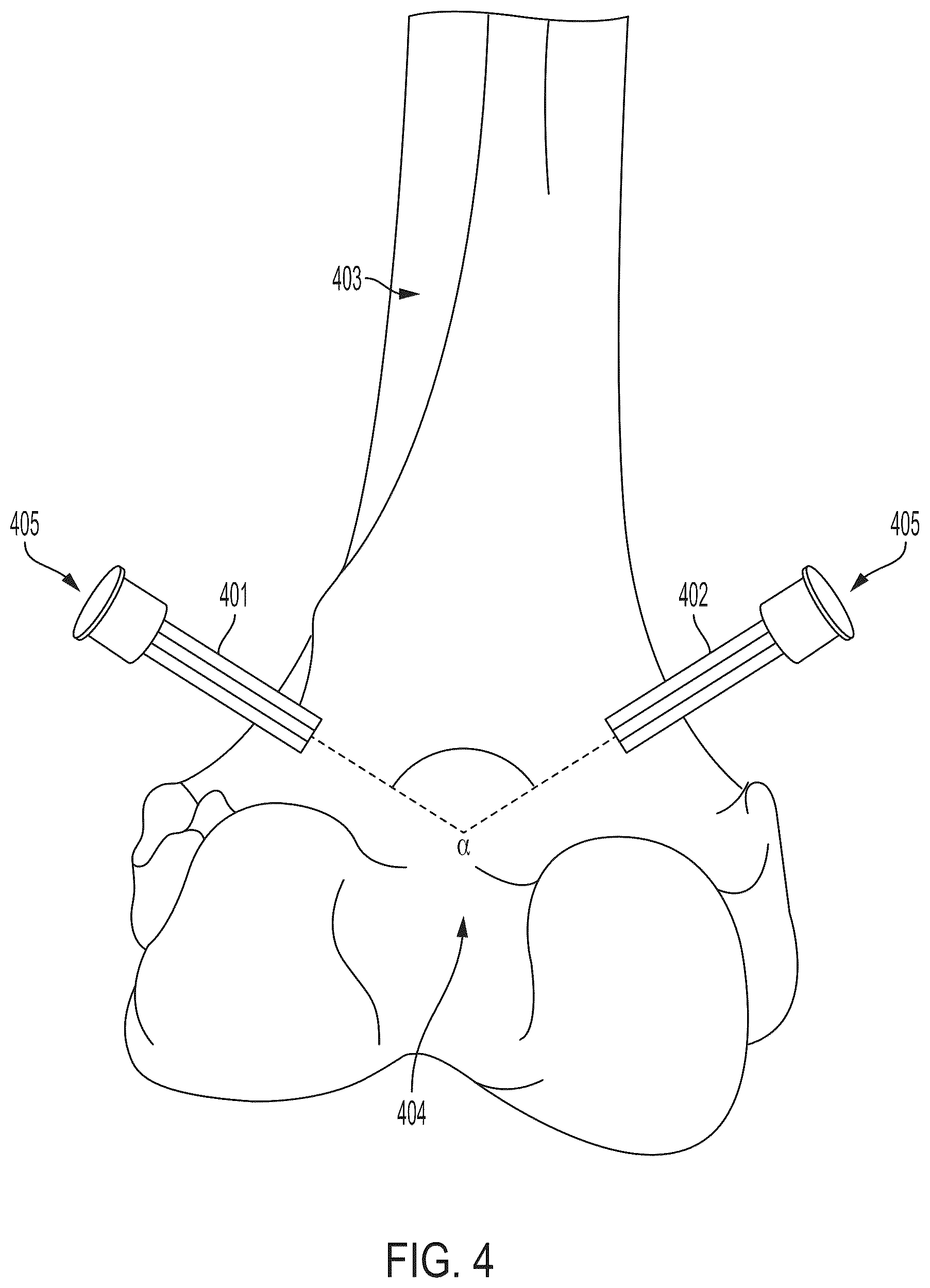 Patent US12303340 Figure 4 – Calibration of 2D images for digital templating using monomarker