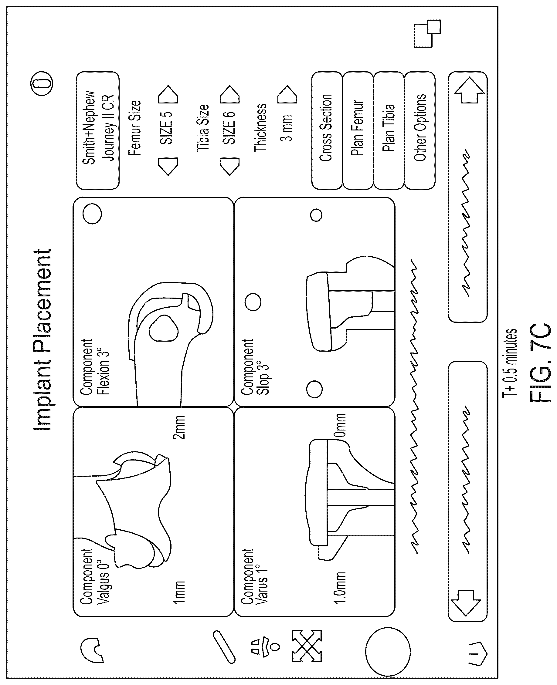 Patent US12303340 Figure 11 – Calibration of 2D images for digital templating using monomarker