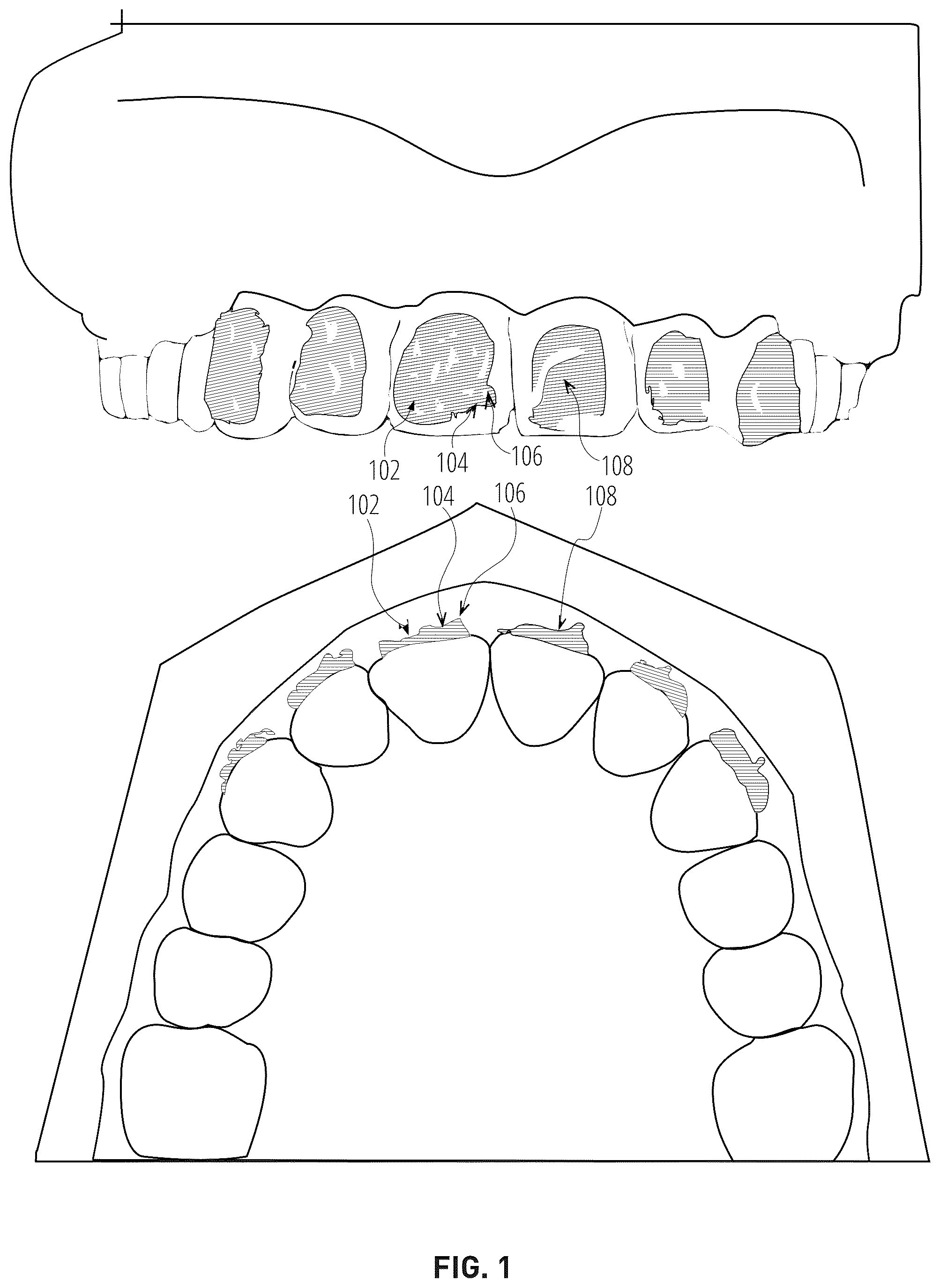 Patent US12303345 Figure 1 – Dental treatment tray