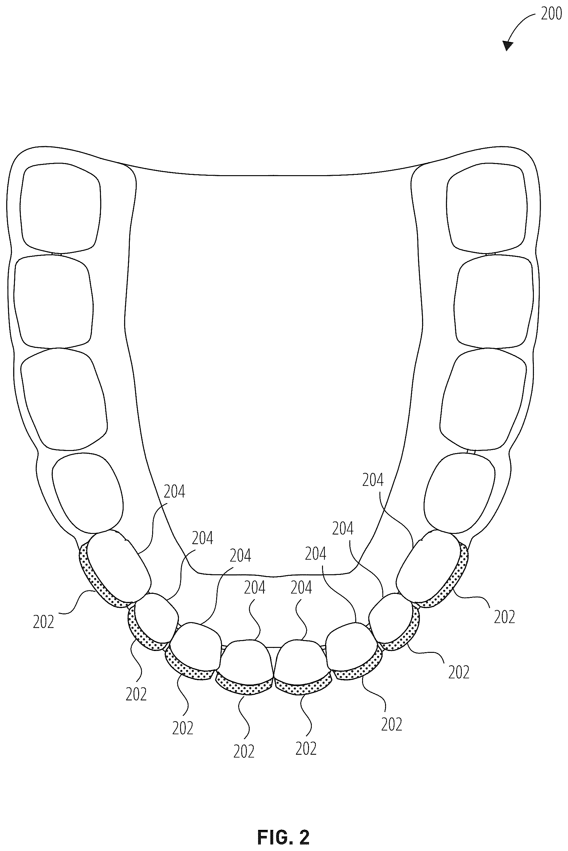 Patent US12303345 Figure 2 – Dental treatment tray