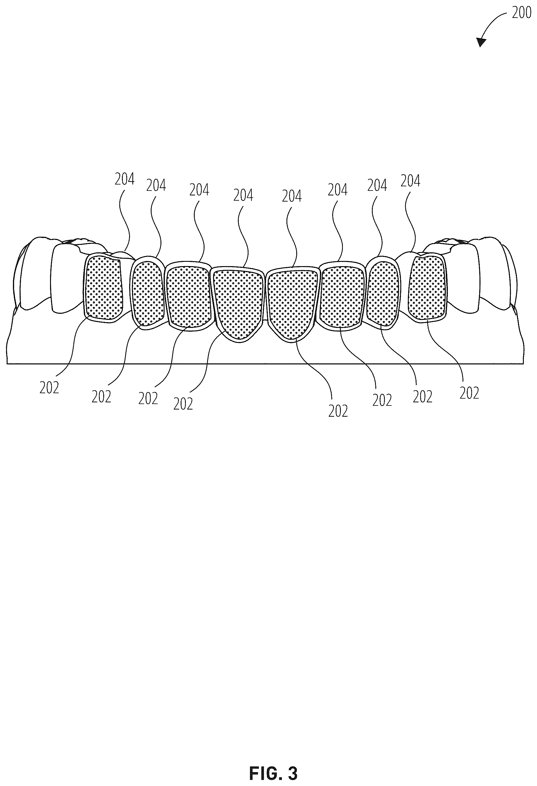Patent US12303345 Figure 3 – Dental treatment tray