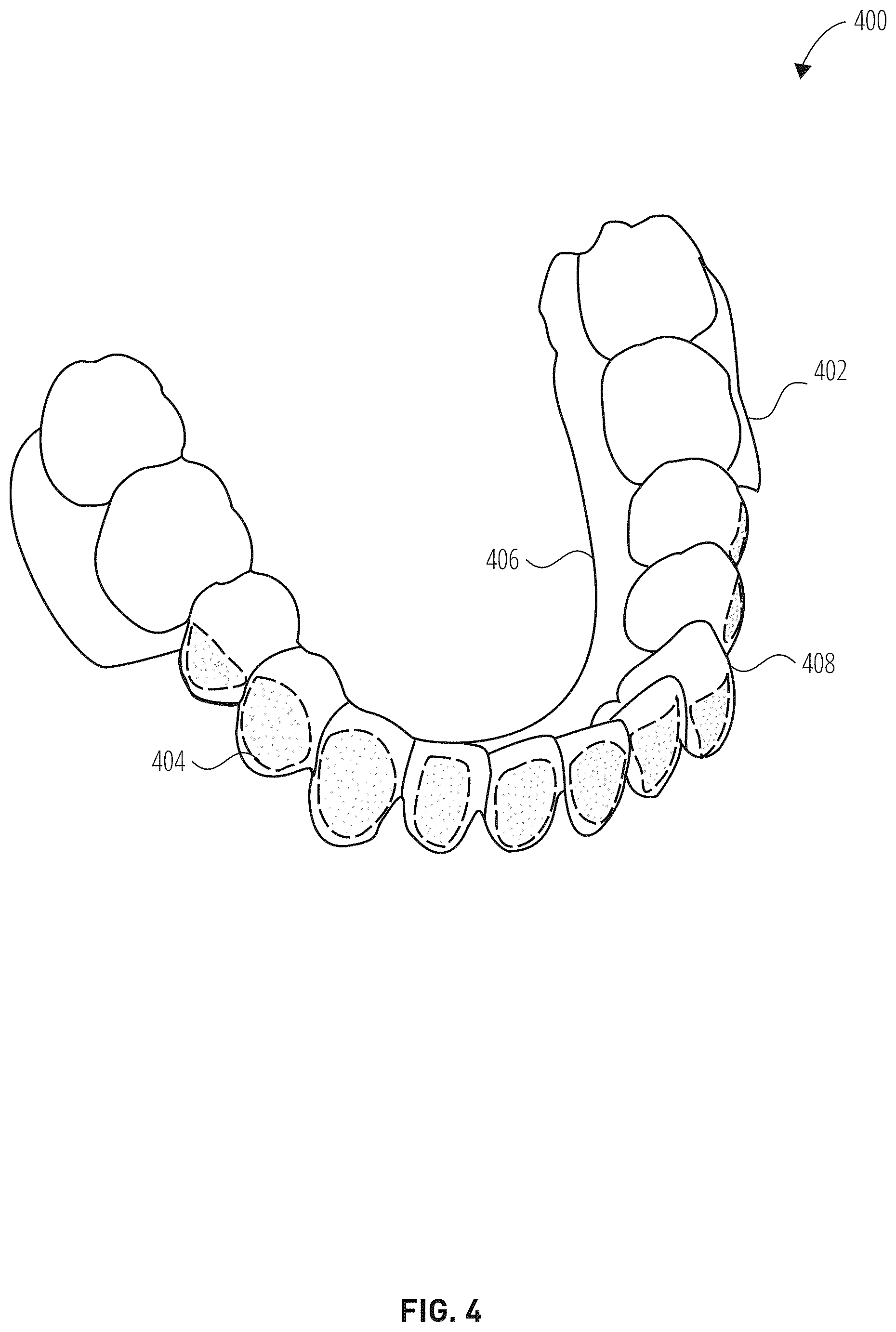 Patent US12303345 Figure 4 – Dental treatment tray