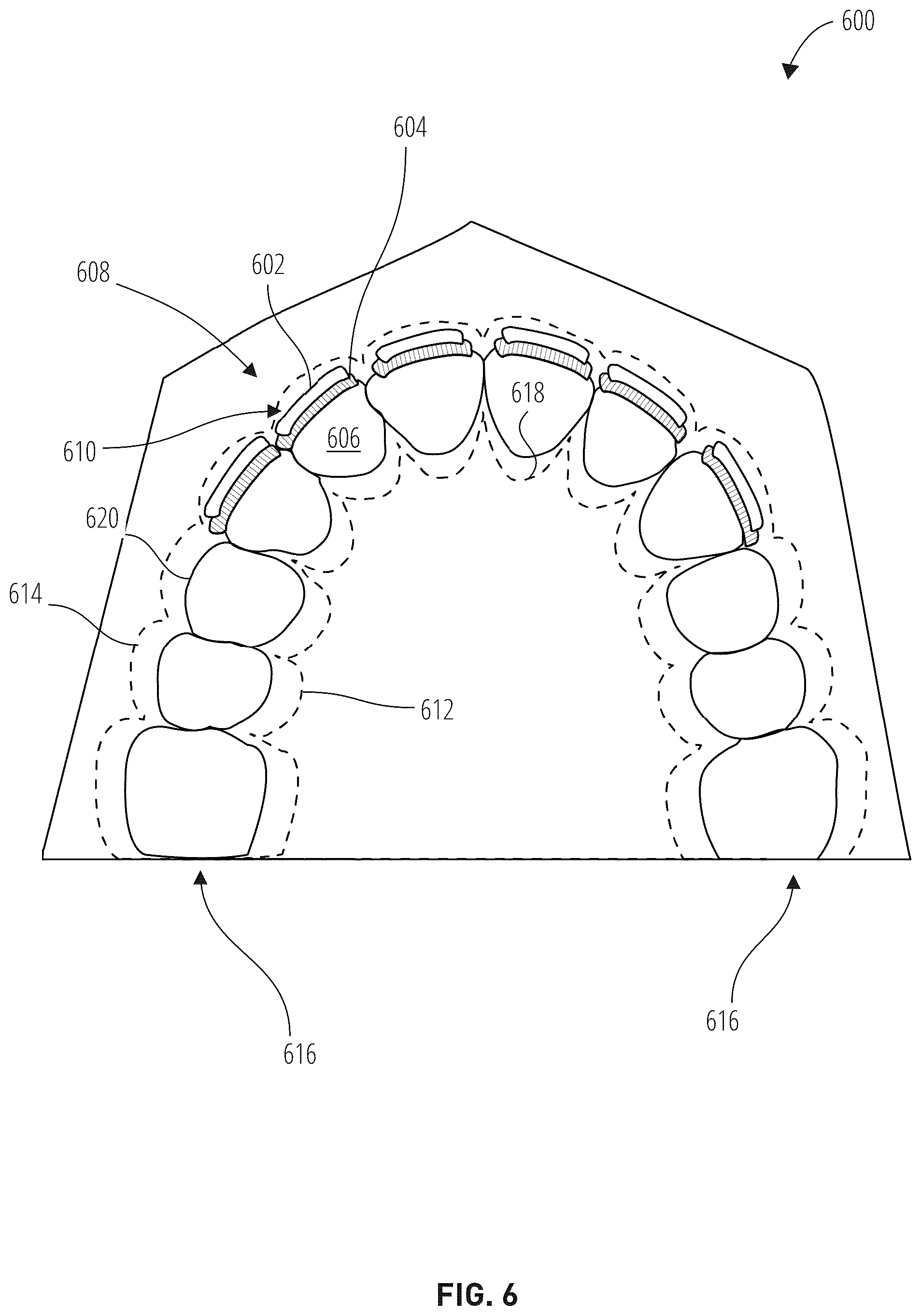 Patent US12303345 Figure 6 – Dental treatment tray