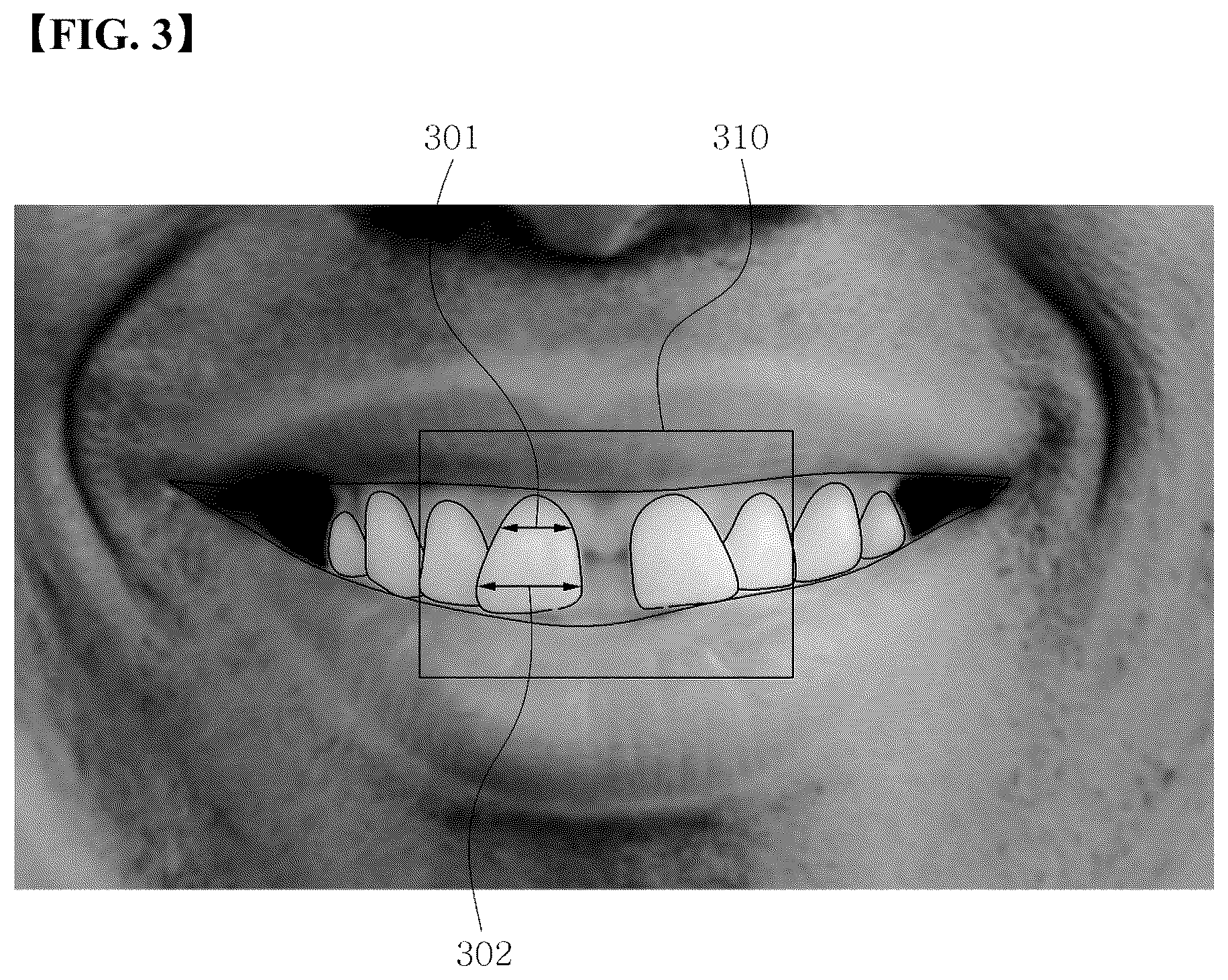 Patent US12303348 Figure 2 – Generating a 3D tooth modeling file adjusted for tooth size for manufacturing a 3D dental laminate