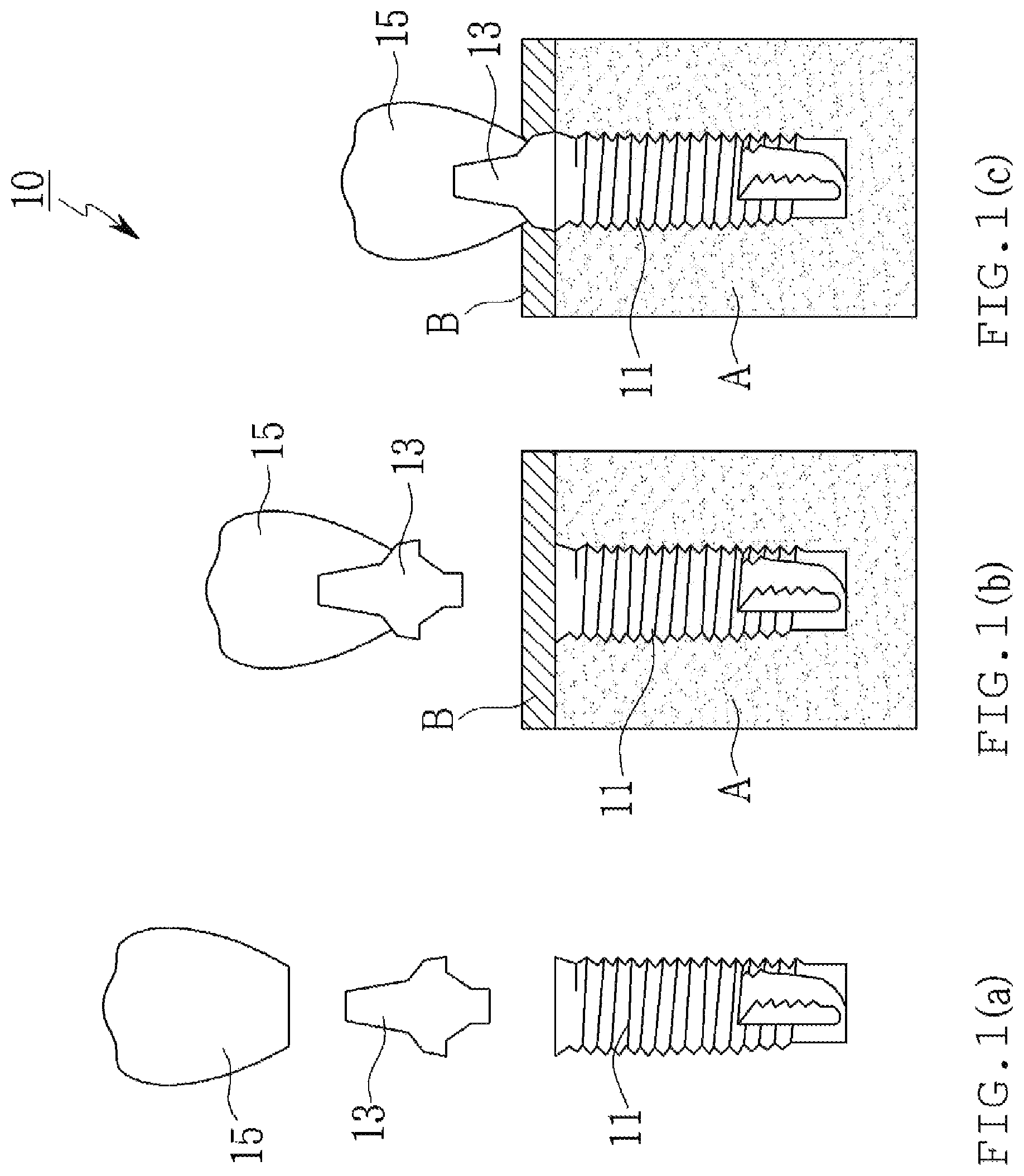 Patent US12303350 Figure 1 – Lateral wall supported implant system with supporting screw surgical guide
